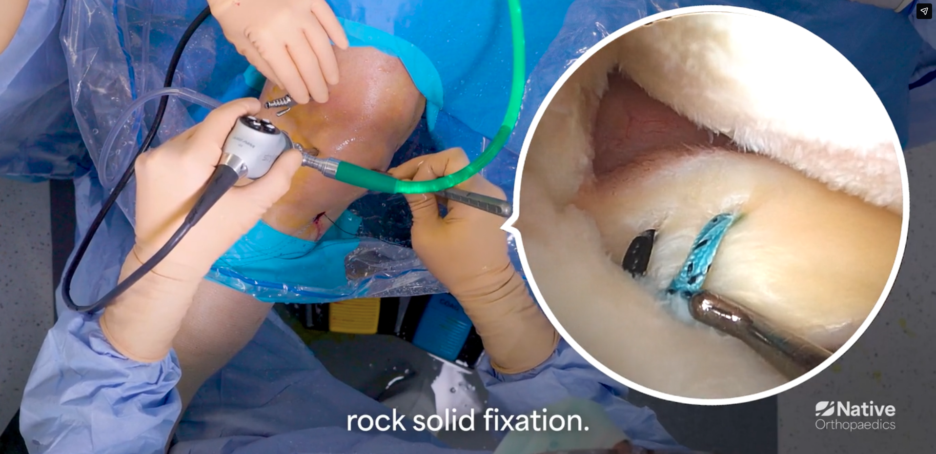 Native Root Step 9: Cycle the joint &amp; final fixation