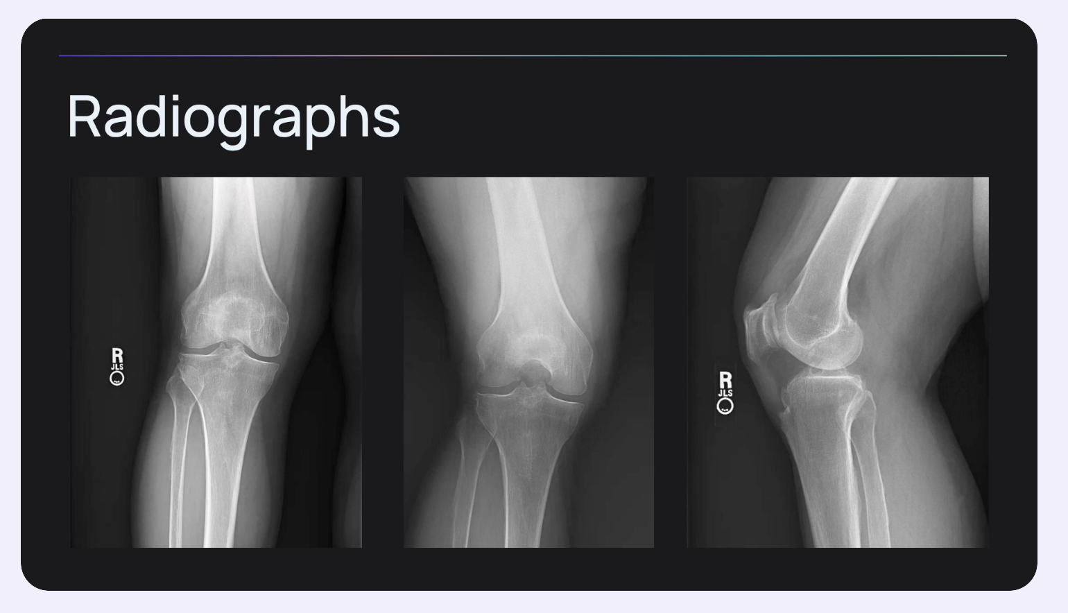 Meniscus Root Tear Case: Biomechanics, Tunnel Placement &amp; Retensionable Repair Technique