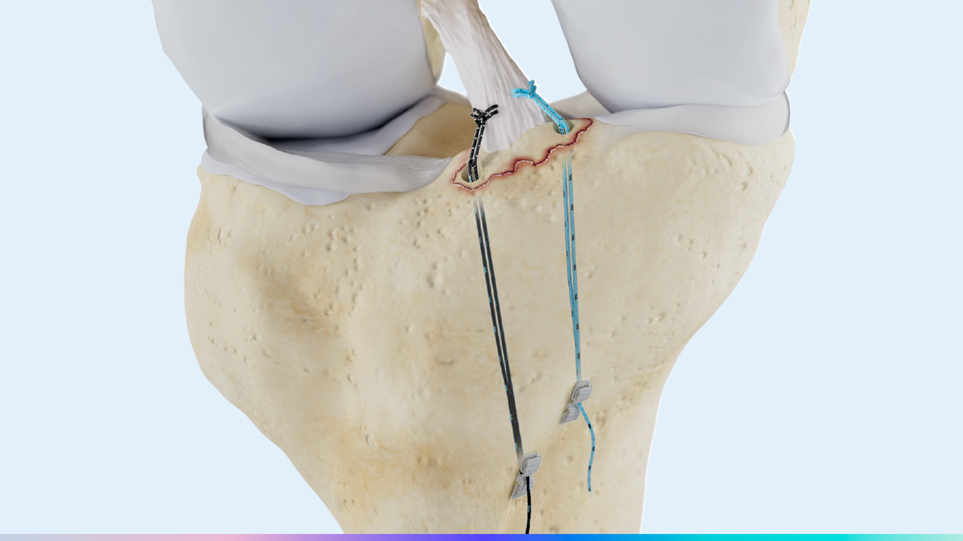 Native Orthopaedics Receives additional FDA 510(k) Clearances for the Repair Construct Across Shoulder, Foot and Ankle, and Knee Indications