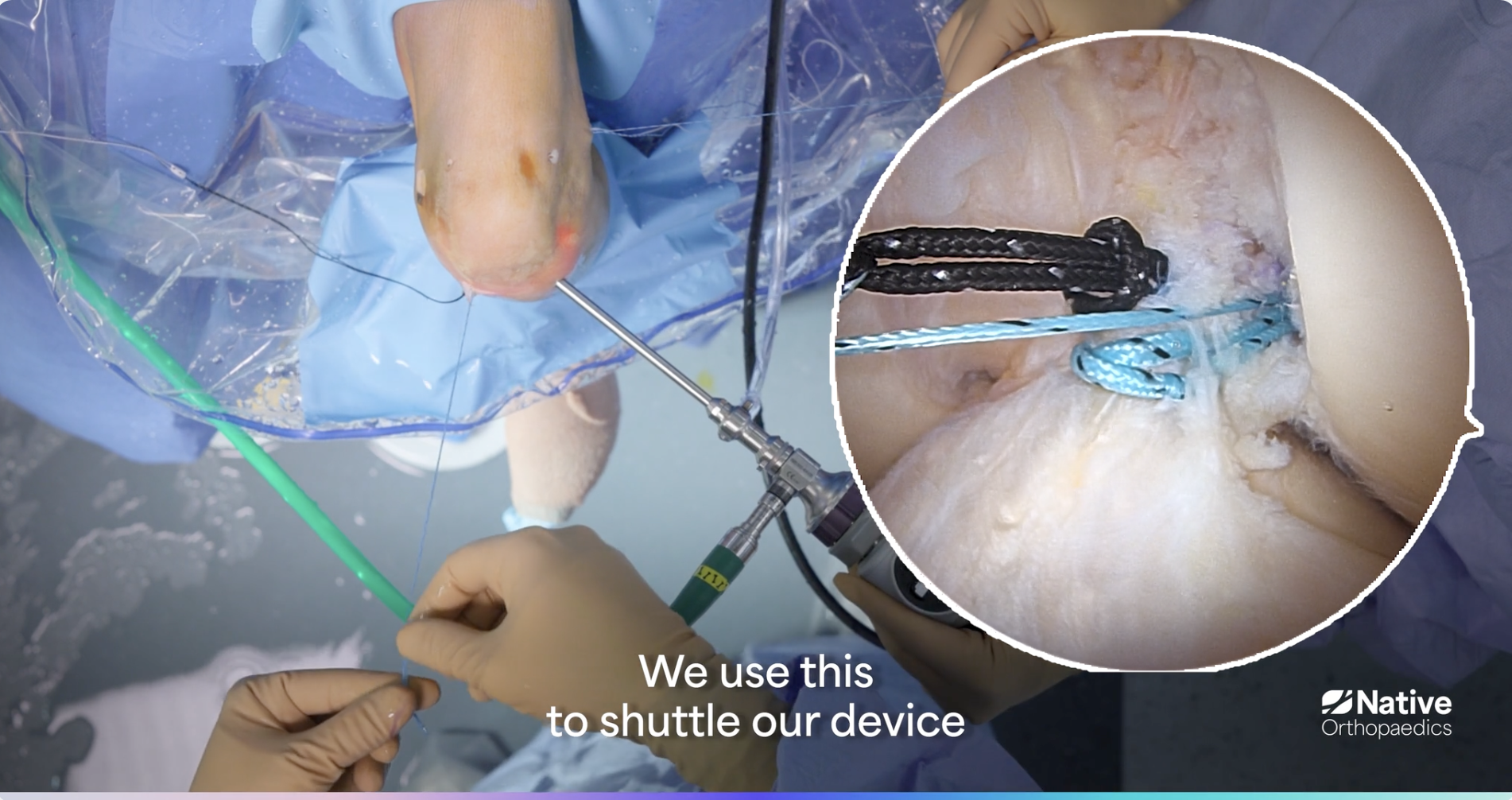 Primary ACL Repair - Prime Zero Surgical Technique