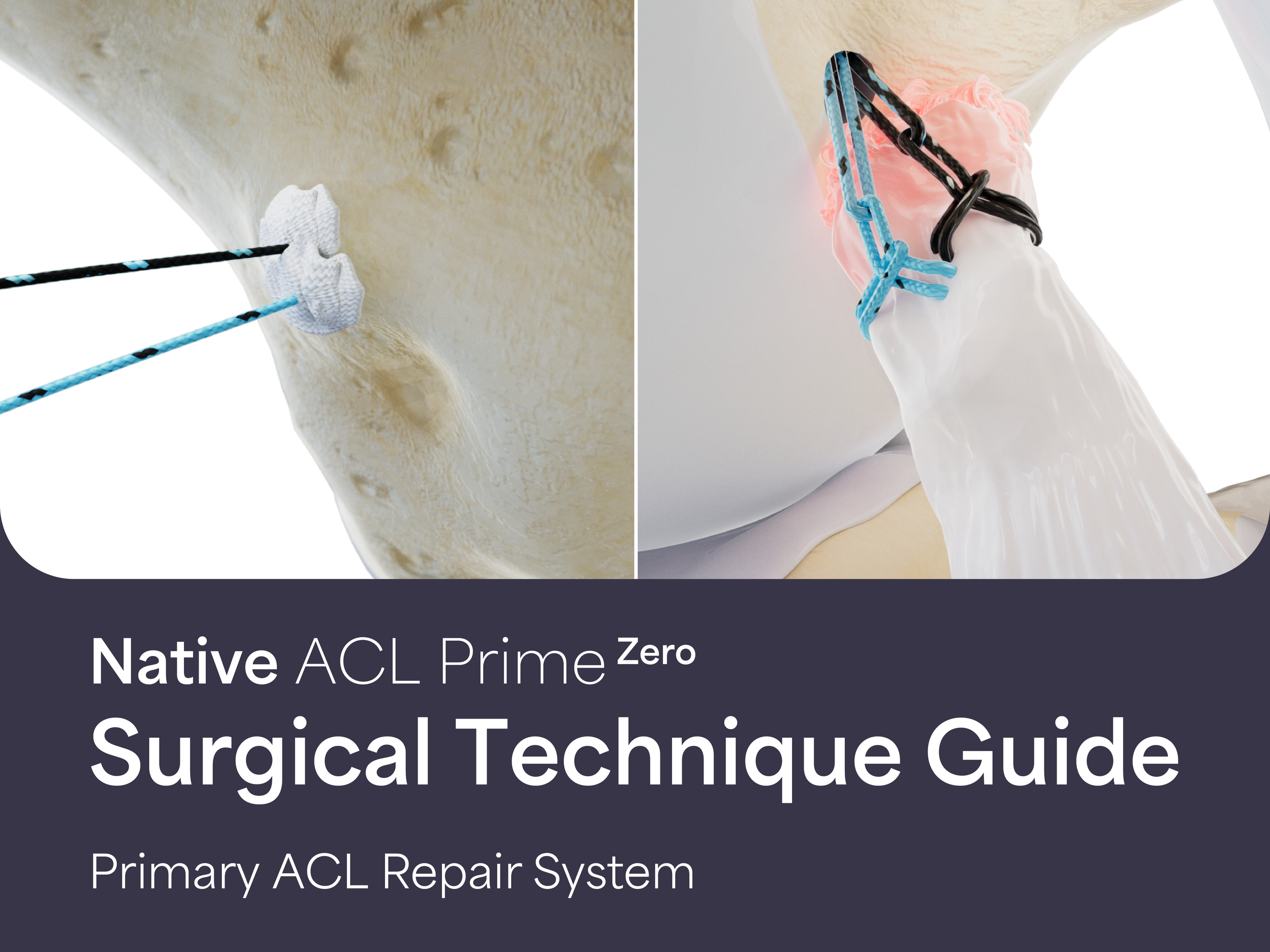 Native ACL Prime Zero: Surgical Technique Guide