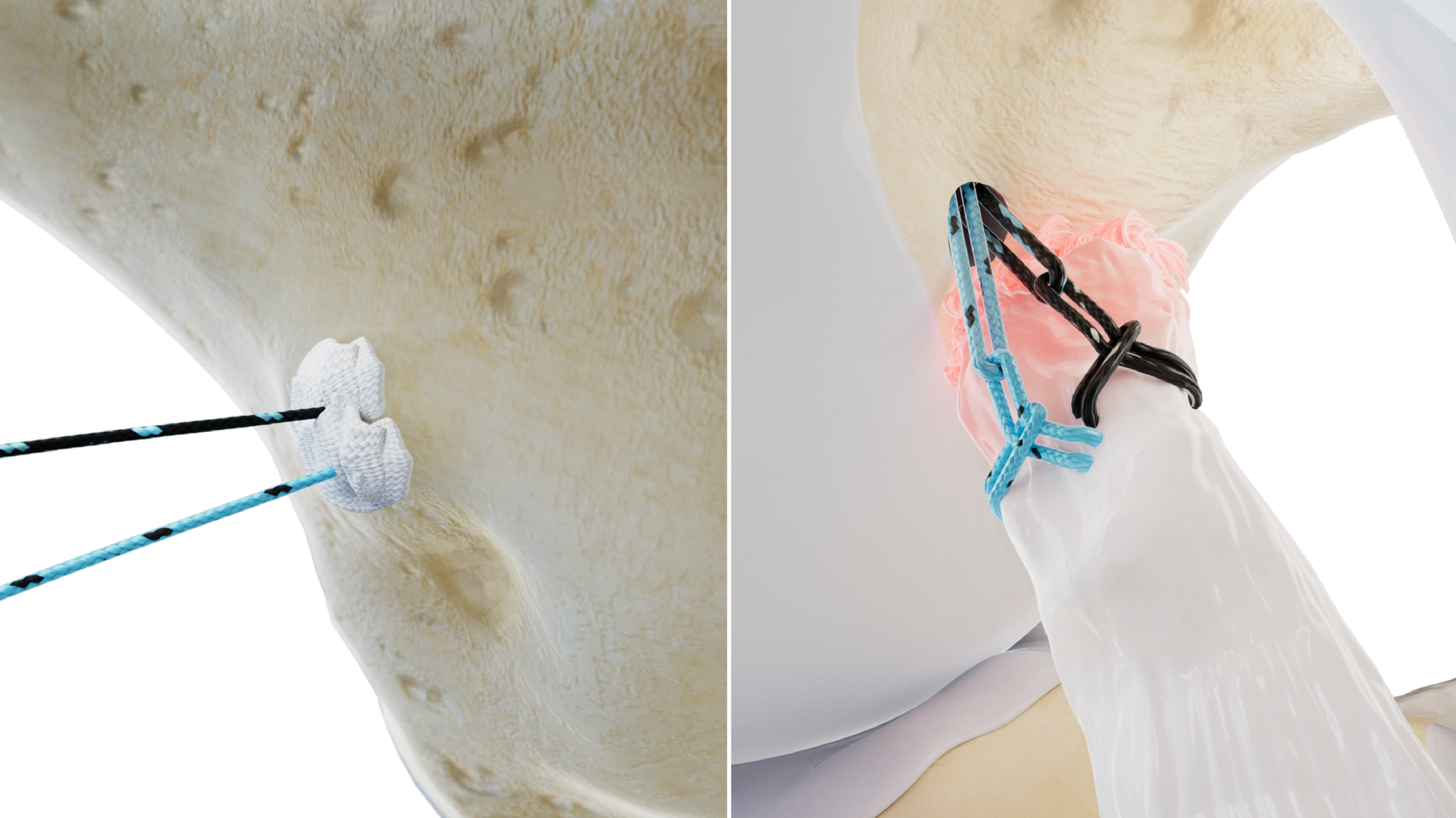 Native ACL Prime Zero: Surgical Technique Guide