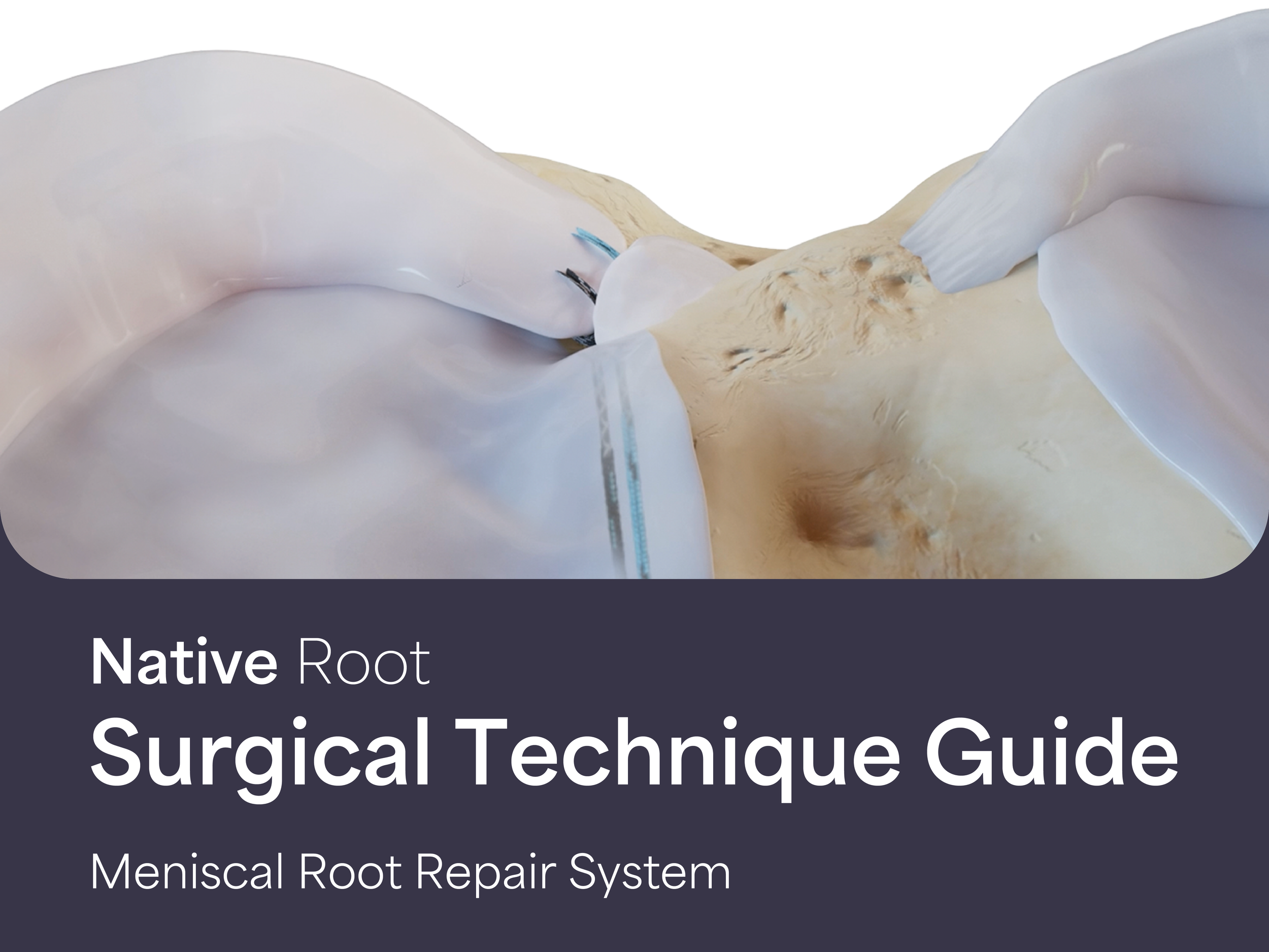 Native Root: Surgical Technique Guide