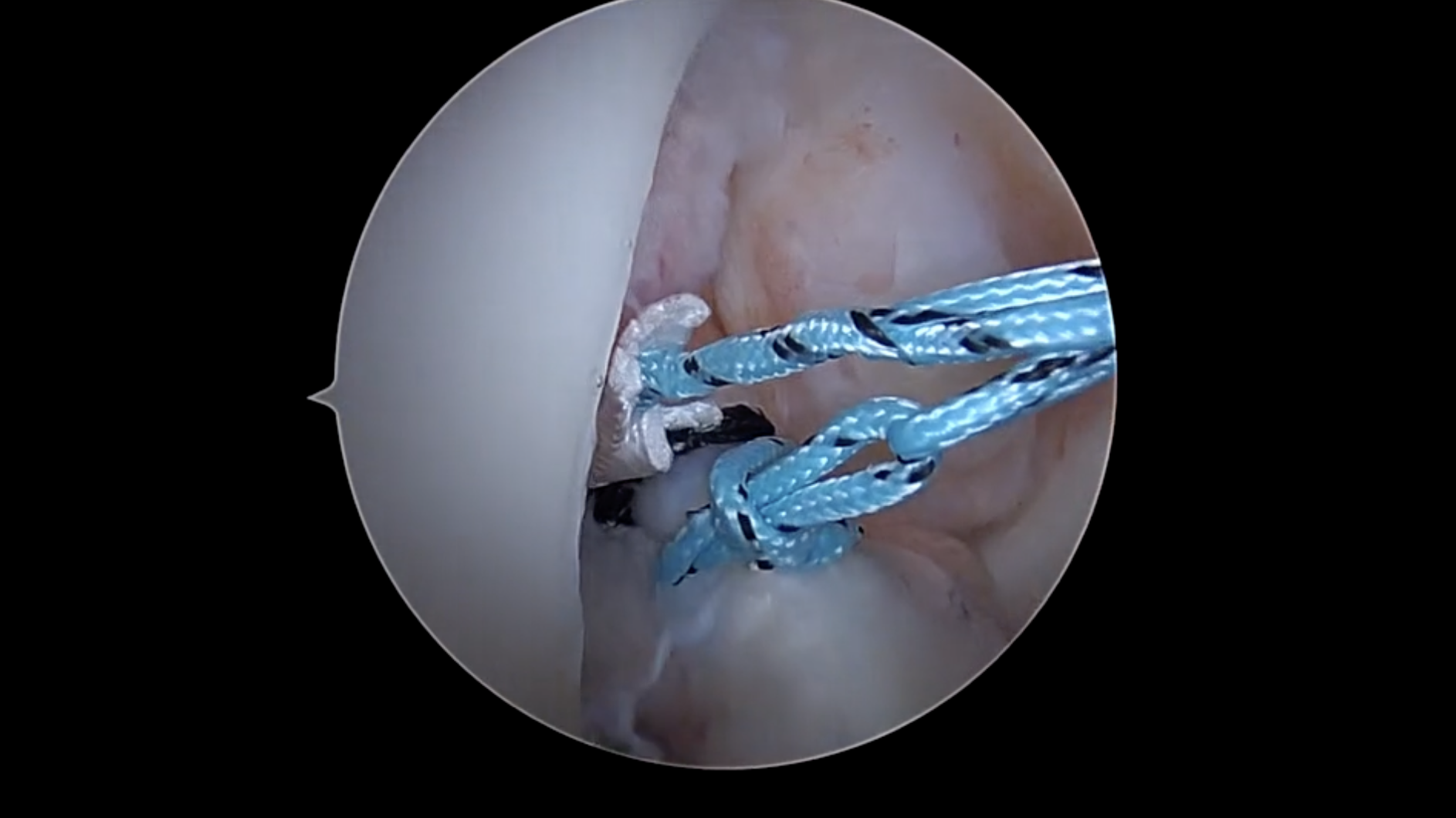 ACL Prime Zero with a Surprise Lateral Native Root - Live Scope Footage