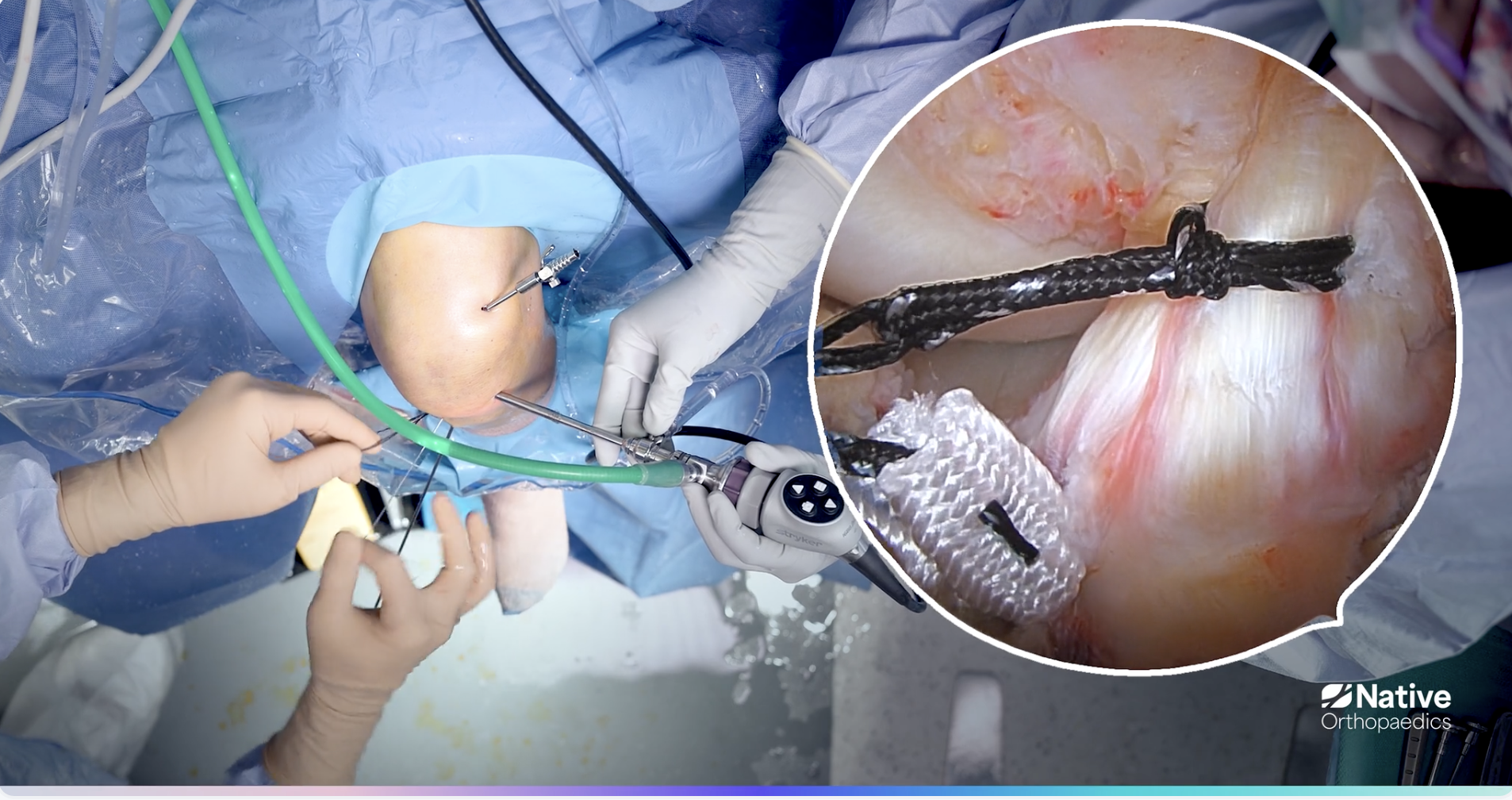 Tibial Eminence Repair: Surgical Video Highlights