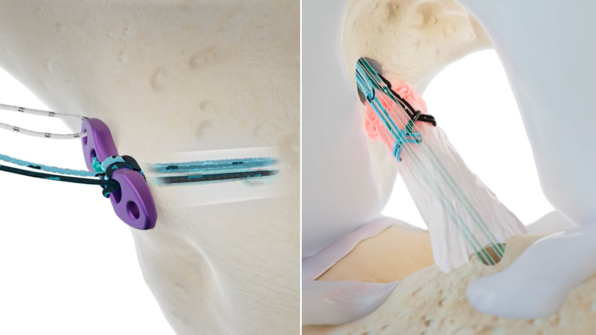 Native ACL Prime: Surgical Technique Guide