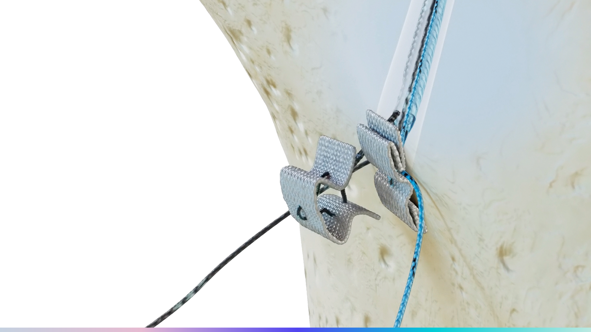 Native Root - Introducing Soft Button Fixation