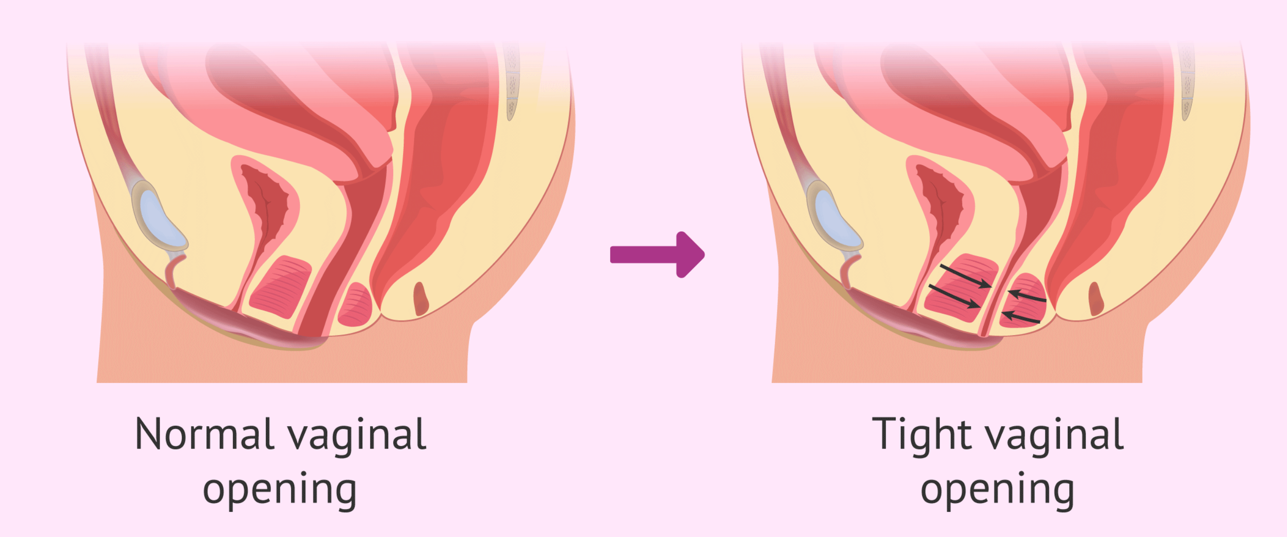 Introduction to Vaginismus