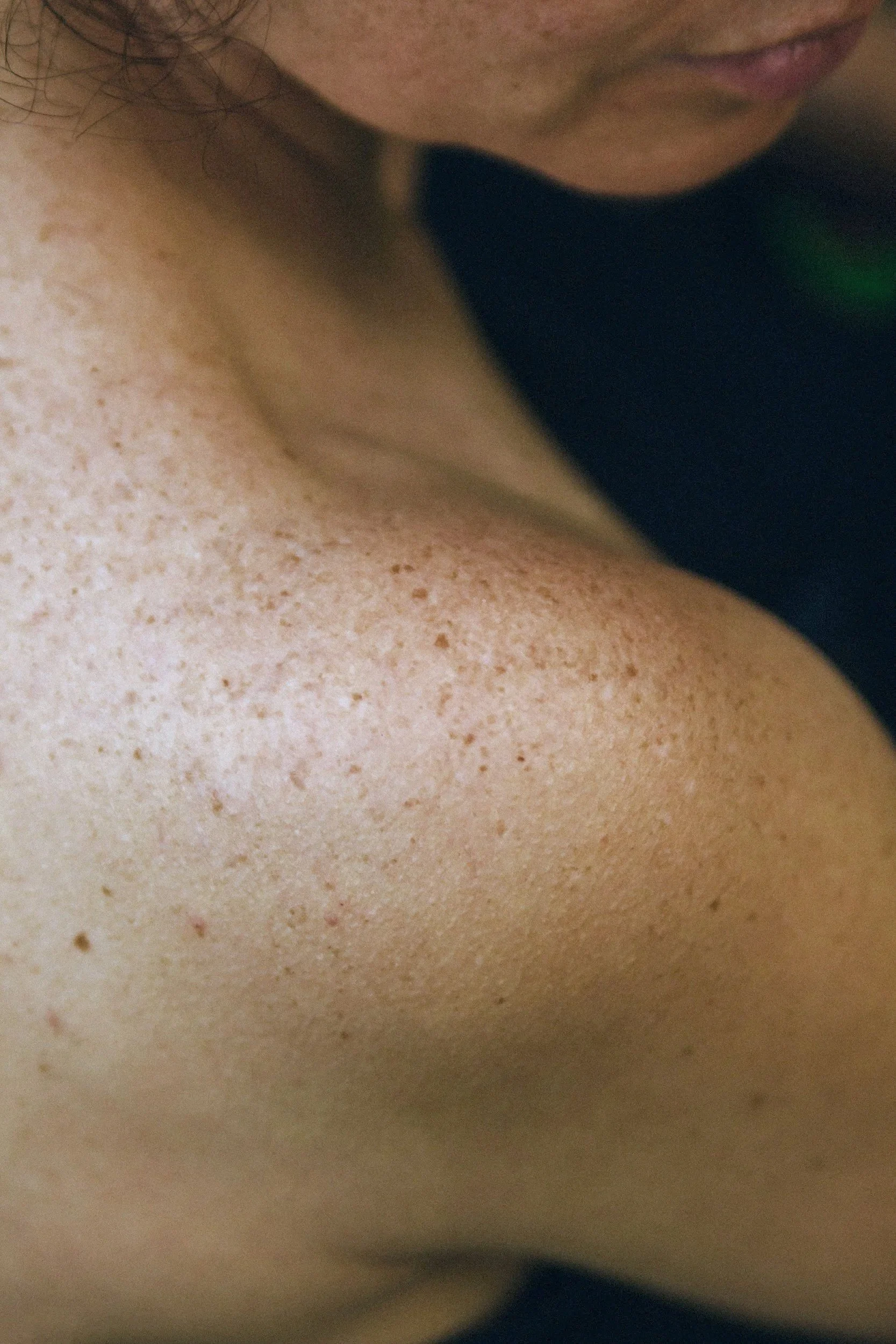 Botulinum toxin Botox Injections