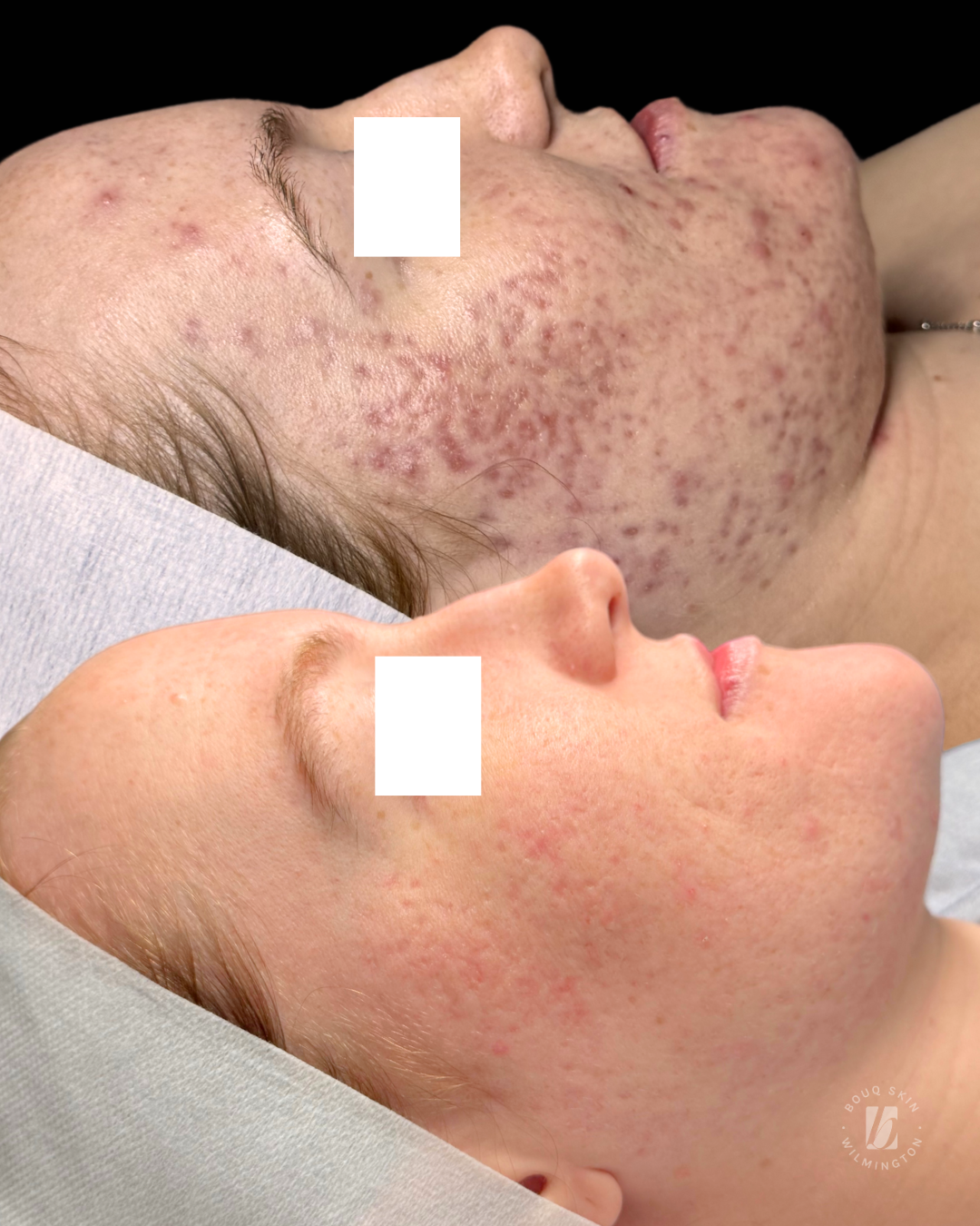 1 Year Transformation: Treating Post-Inflammatory Erythema (PIE) and Ice Pick Acne Scars
