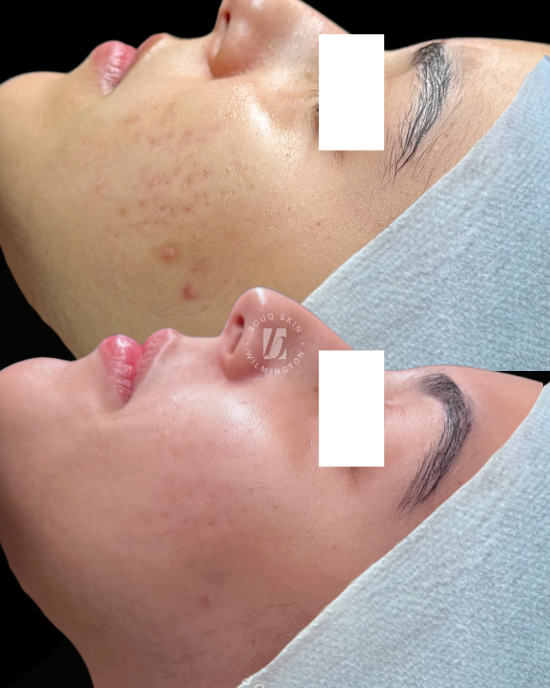 Pregnancy-Safe Skincare: Transforming Acne and Hyperpigmentation with Science