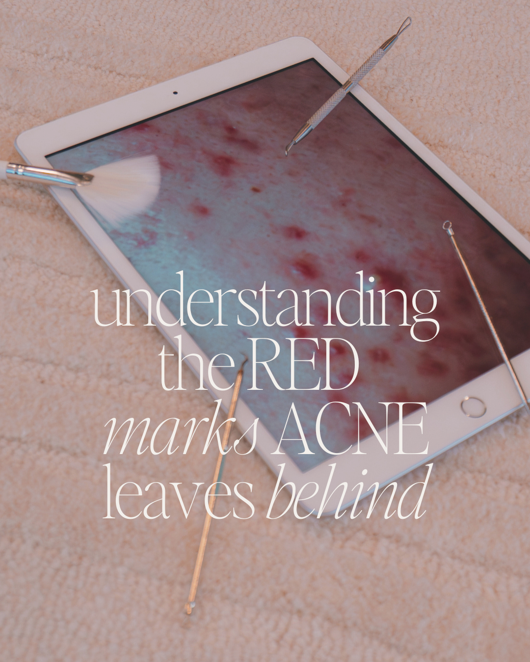 Red Acne Marks After Breakouts: Understanding Post-Inflammatory Erythema (PIE) and How to Treat It