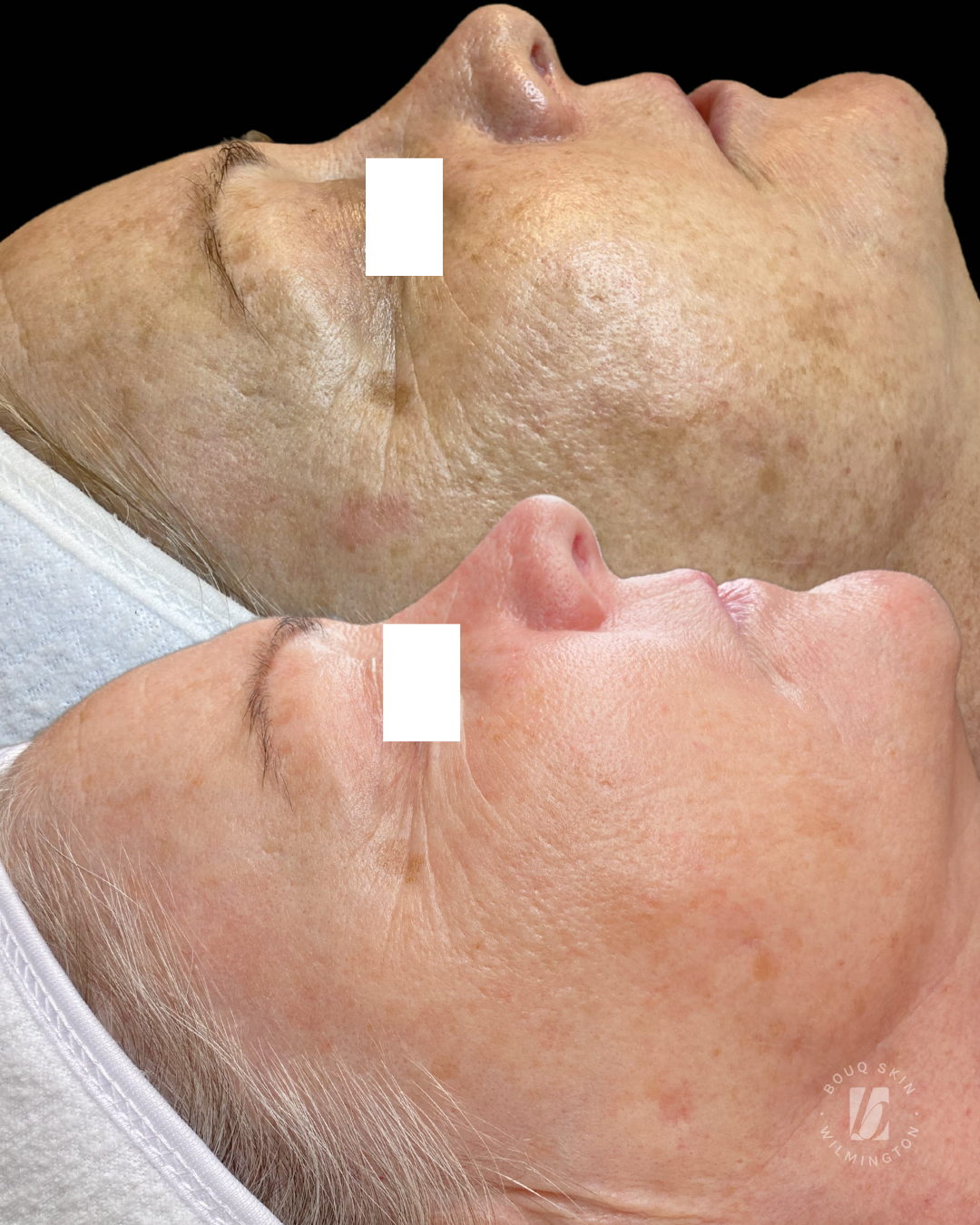 Lasting Pigment Control with Aerolase and Lira Chemical Peels