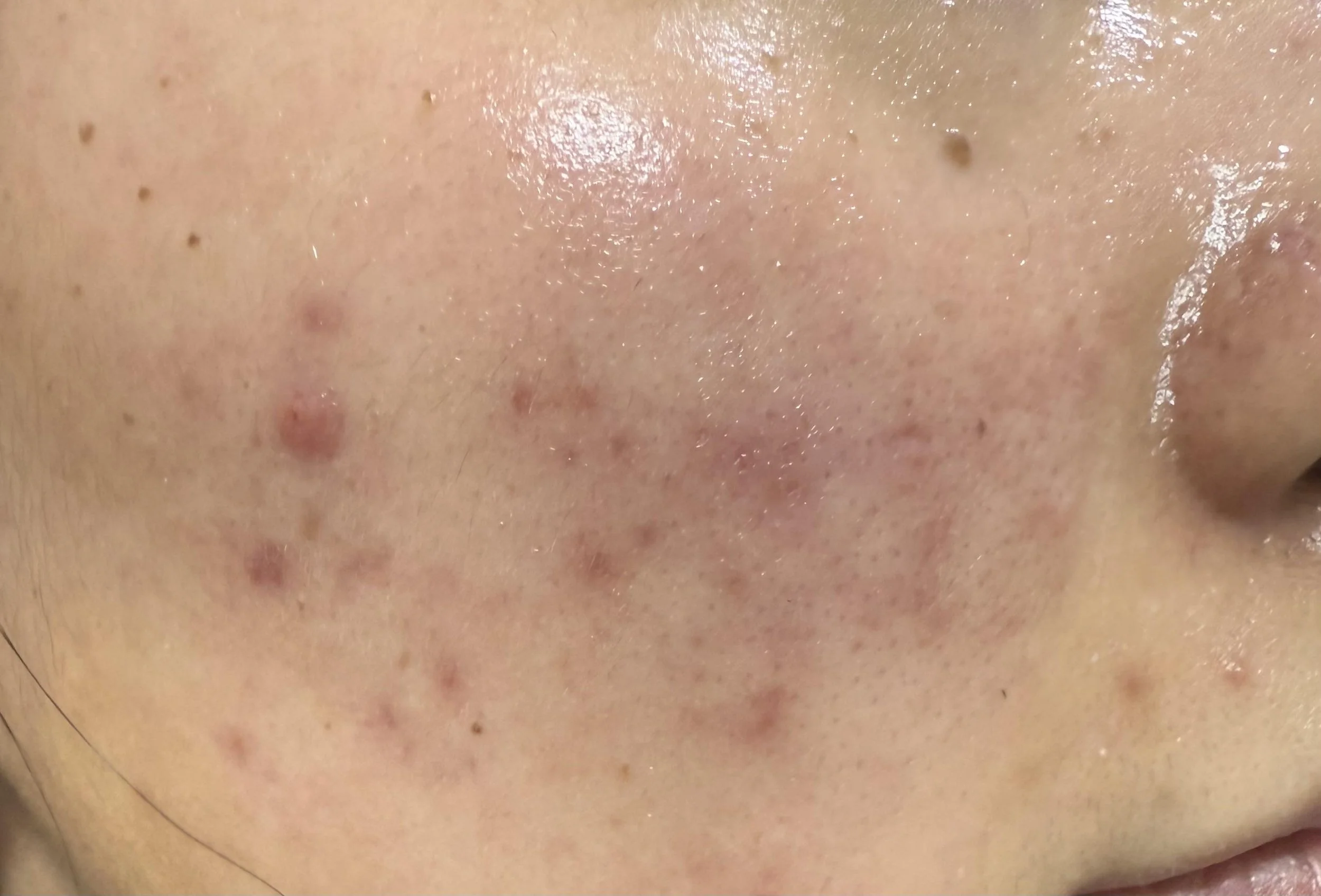 Acne Scars? Here’s What Actually Works According to Wilmington Skin Experts