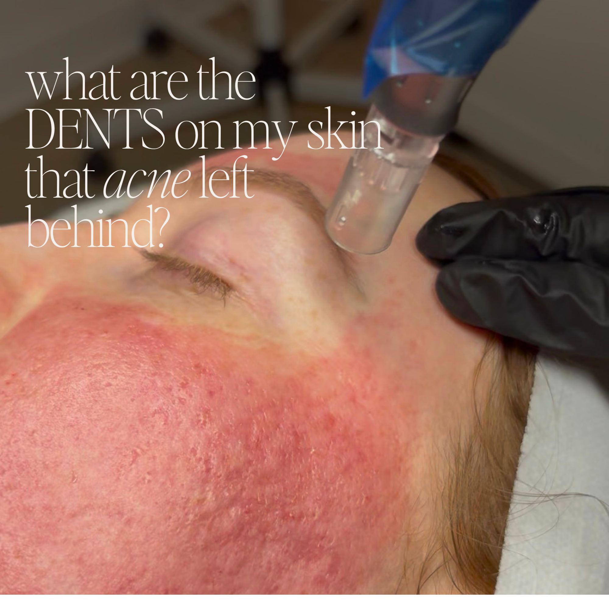Acne Scars Explained