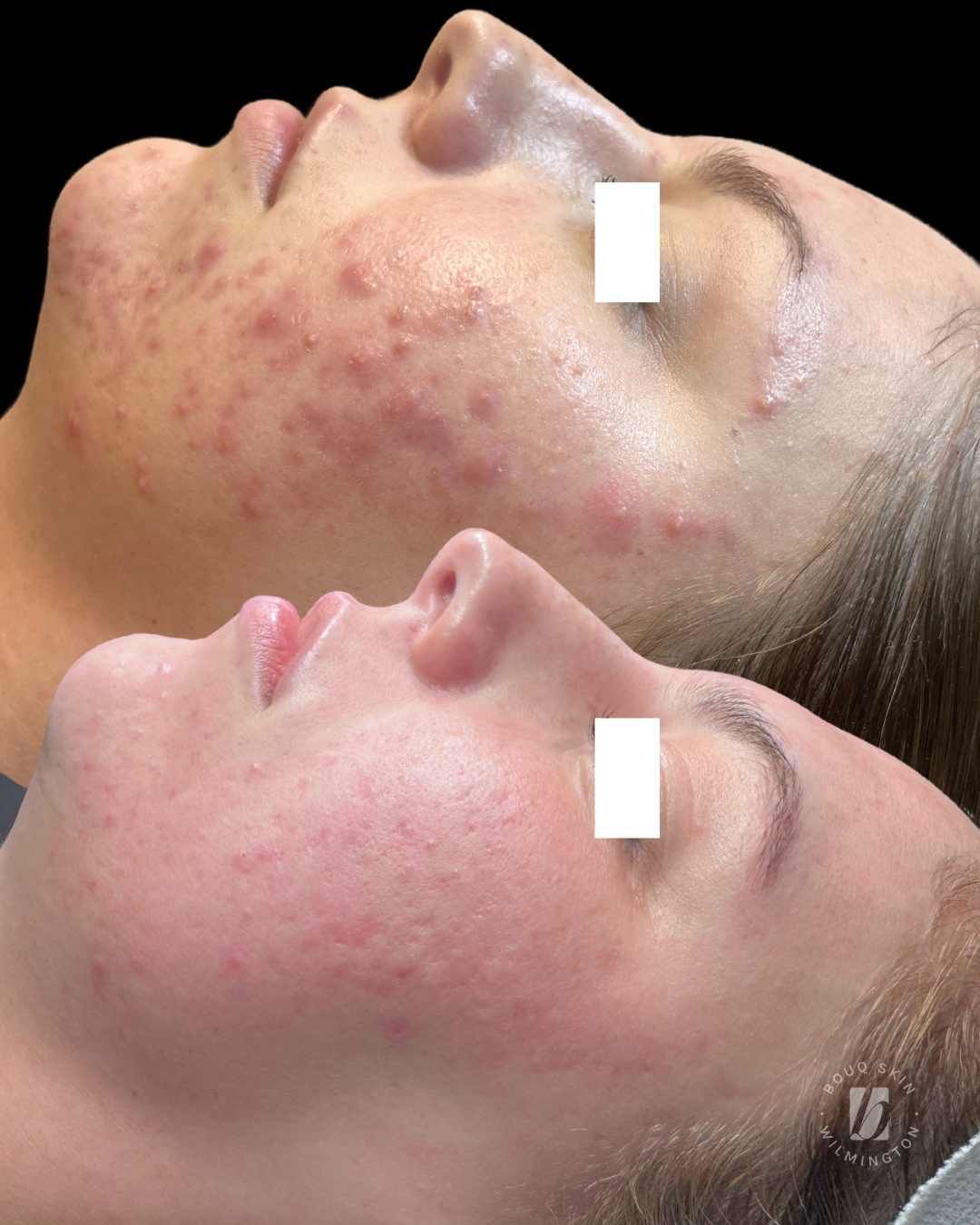 How to Get Rid of Cystic Acne (Professional Treatments That Actually Work)
