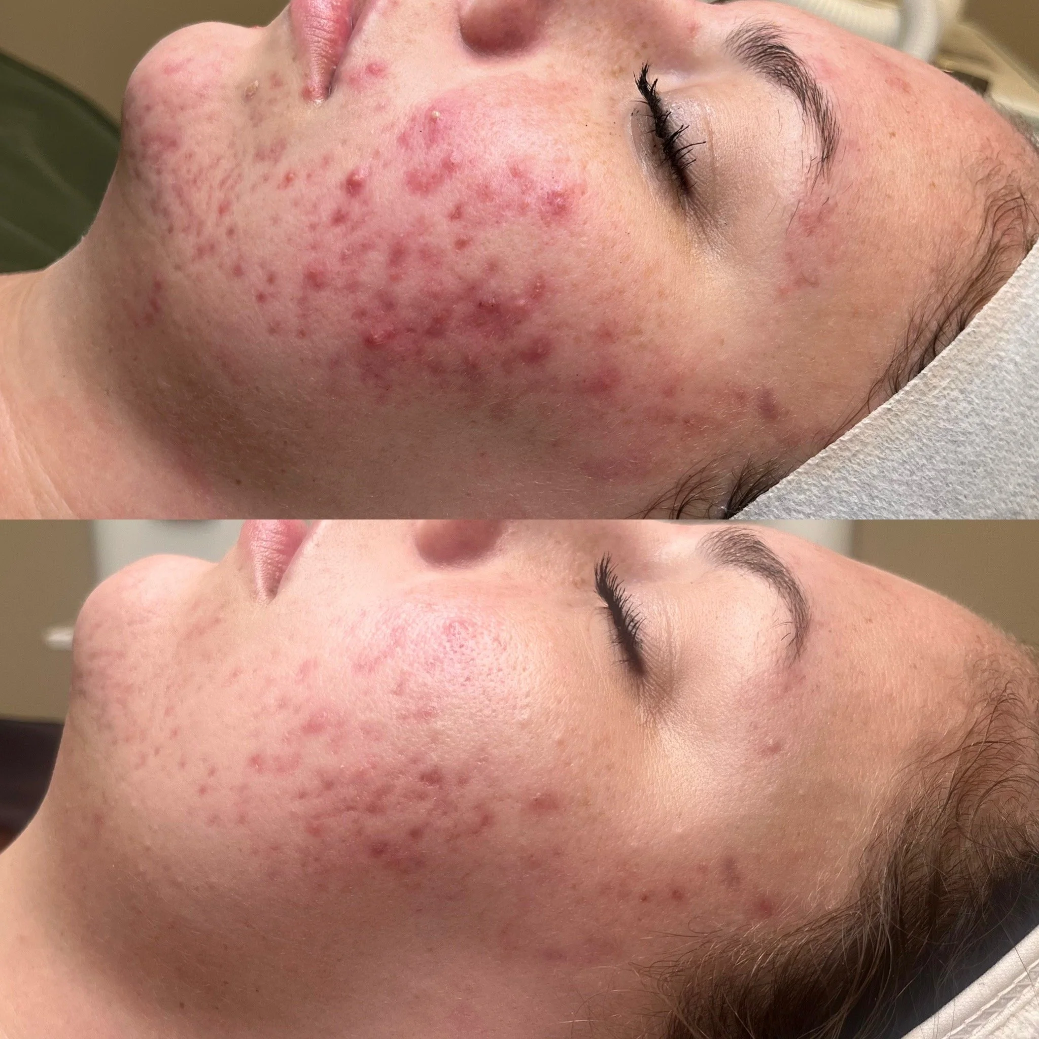 Close-up of a woman's face showing before and after skin treatment for acne, with improved skin appearance in the after photo.