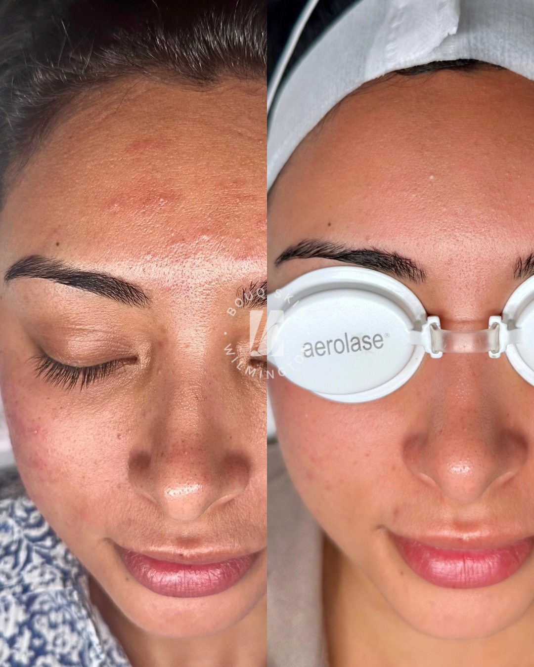 Side-by-side images of a woman's face showing improvement in skin appearance after skincare treatment, with the right side wearing goggles labeled 'aerolase'.