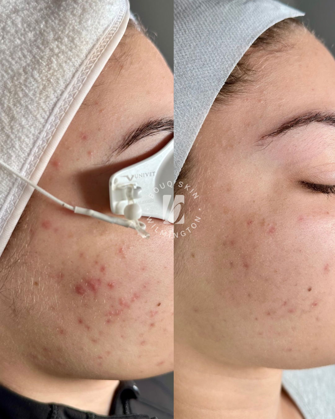 Before-and-after comparison of a person's cheek showing improvement in acne and skin texture.