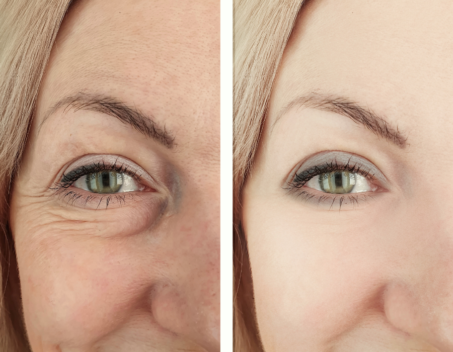 Gilbert Botox 4.png