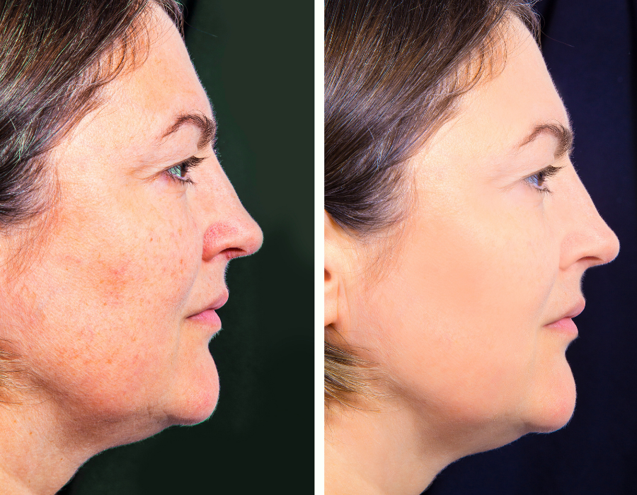 Gilbert Botox 2.png