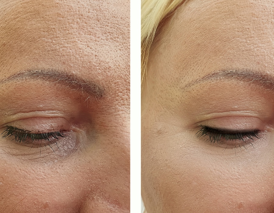 Gilbert Botox 8.png