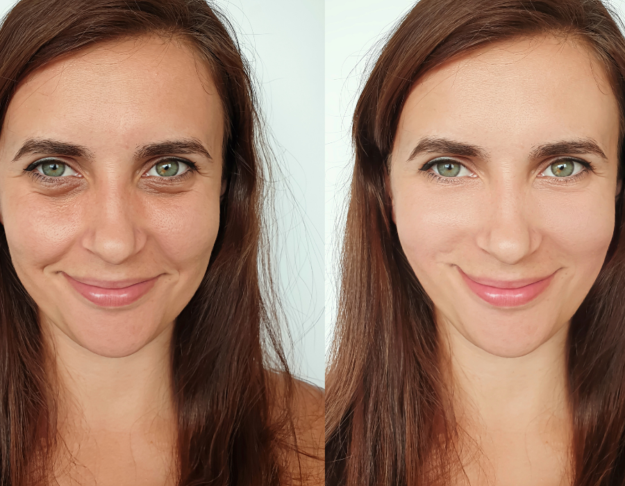 Gilbert Botox.png