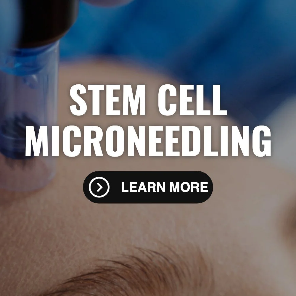 Stem cell microneedling for collagen renewal at M Spa Clinical Aesthetics in Rio Rancho NM