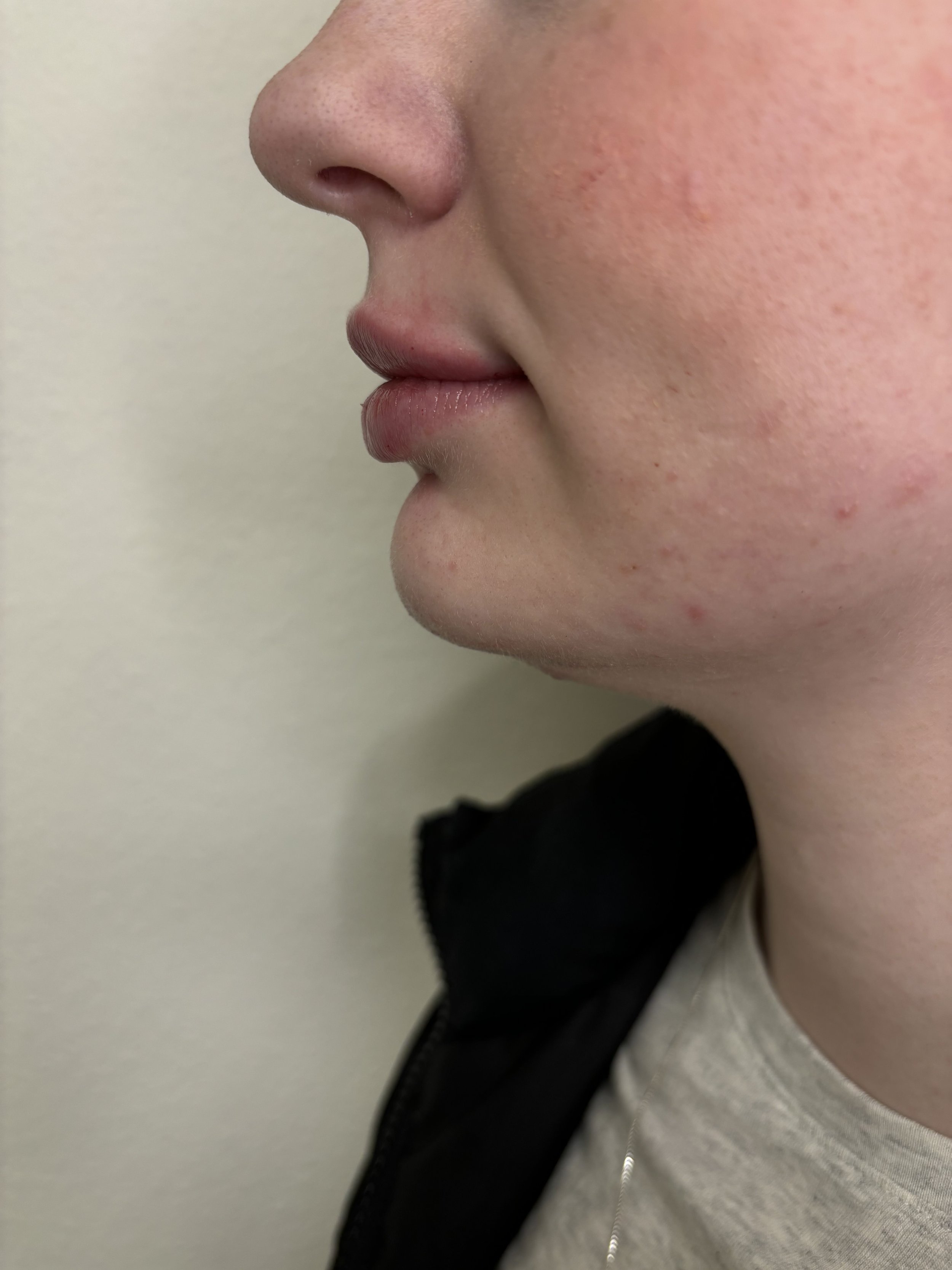 After 1 syringe of lip + chin filler