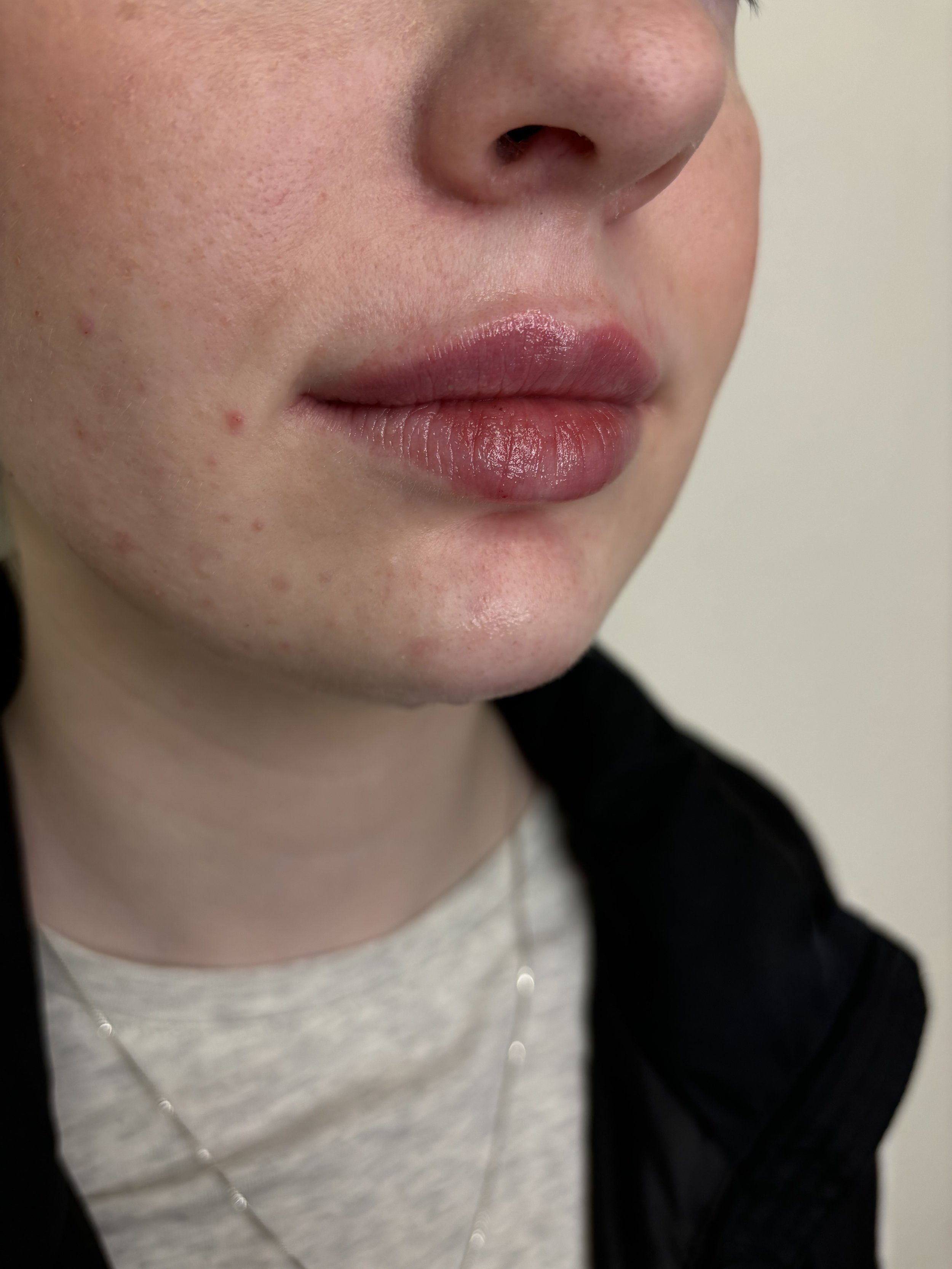 After 1 syringe of lip + chin filler