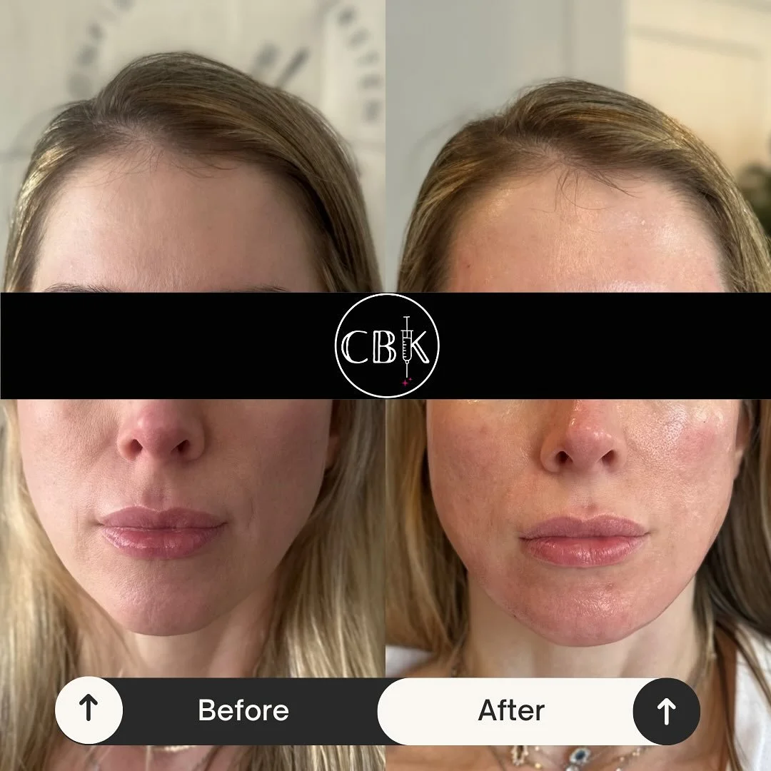 Full face balance = natural, youthful harmony 💫

Radiesse helps restore volume where it&rsquo;s needed most &mdash; temples, cheeks, and lower face &mdash; for lifted support and smoother contours.

Bonus? It stimulates collagen and elastin for a he