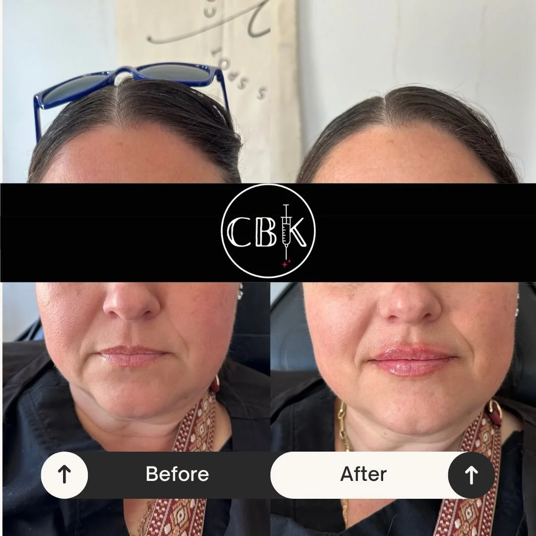 ✨It has been brought to my attention that I haven&rsquo;t posted since October&hellip; So for your viewing pleasure, SOME LIPS! 

This patient was a long time listener, first time caller and I&rsquo;m so proud of her for coming in and choosing to do 