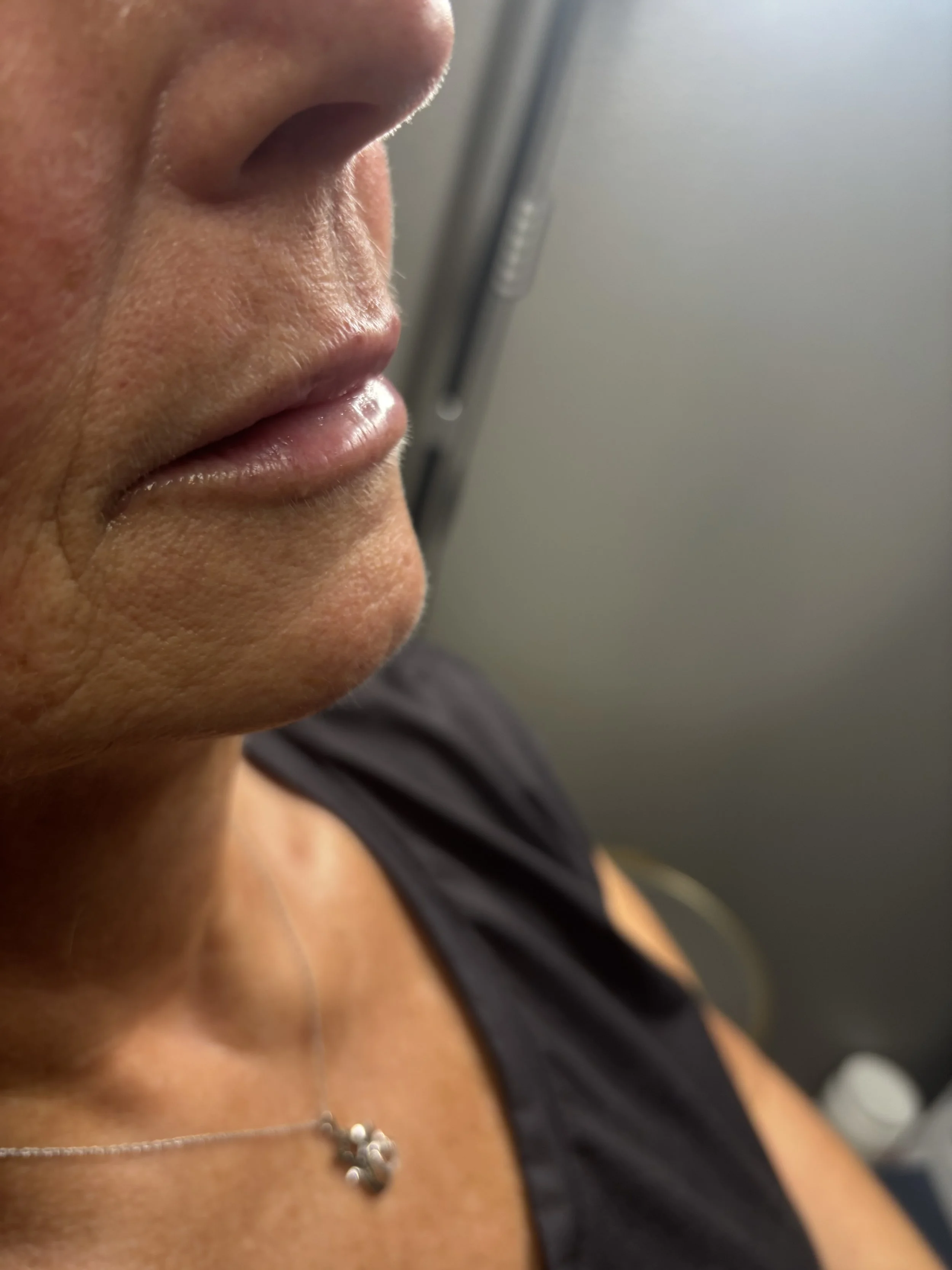Dermal Fillers in Nampa, Idaho: Natural-Looking Lip and Cheek Enhancement