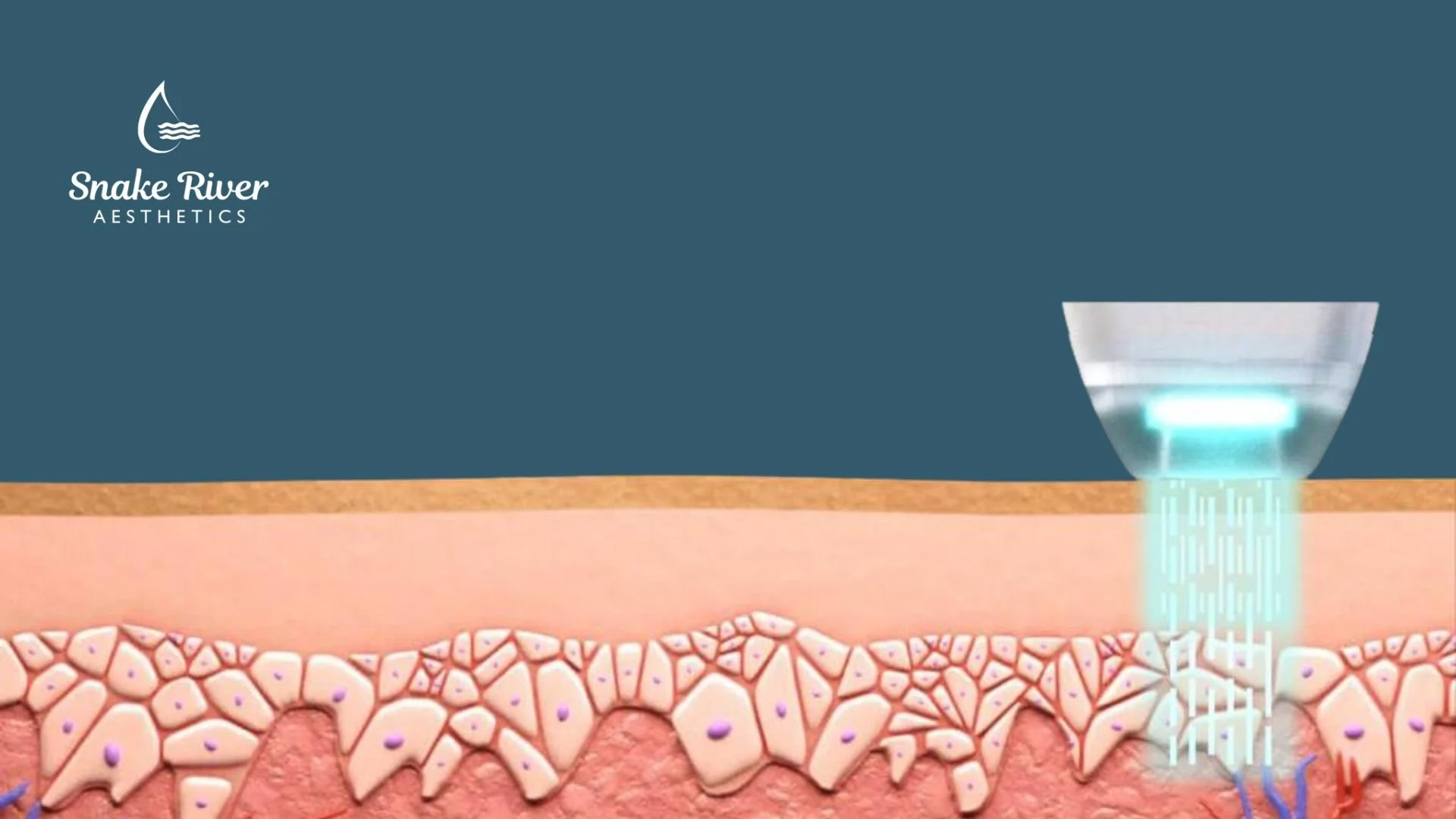 MultiFrax Laser: Can It Really Treat Multiple Skin Concerns at Once?
