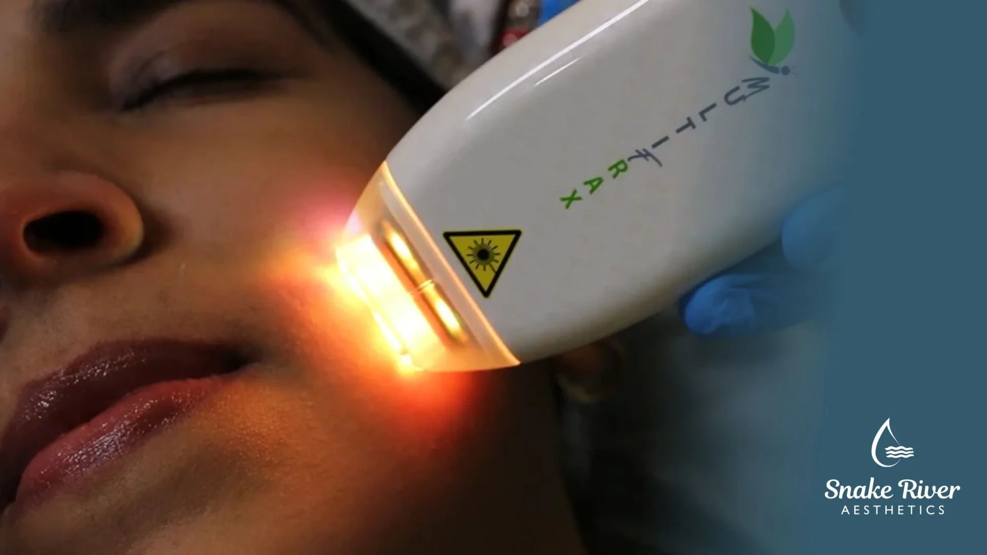 MultiFrax for Acne Scars: What to Know Before Laser Resurfacing 