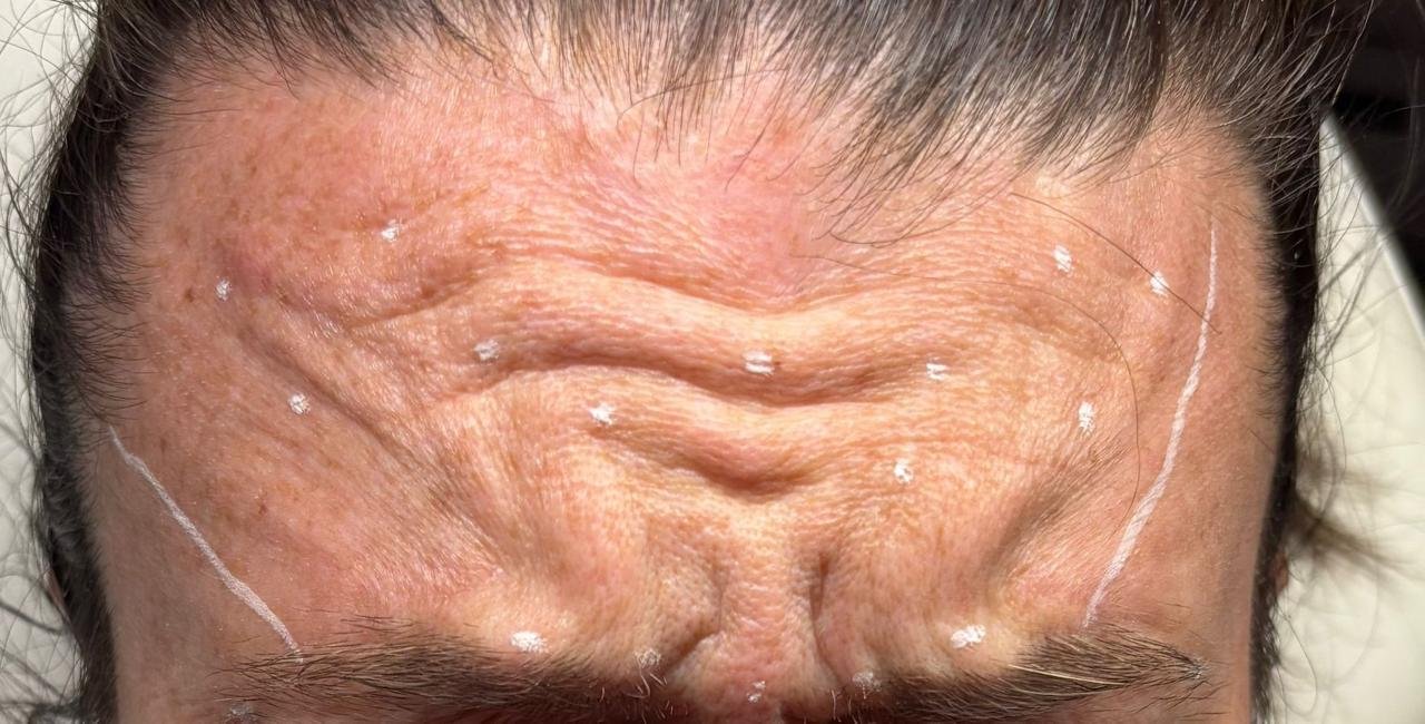 Neuromodulators in Nampa, Idaho: A Natural Approach to Smoothing Expression Lines