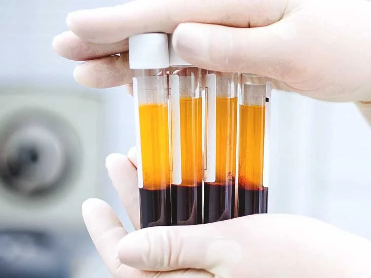 Platelet-Rich Plasma (PRP) Therapy 