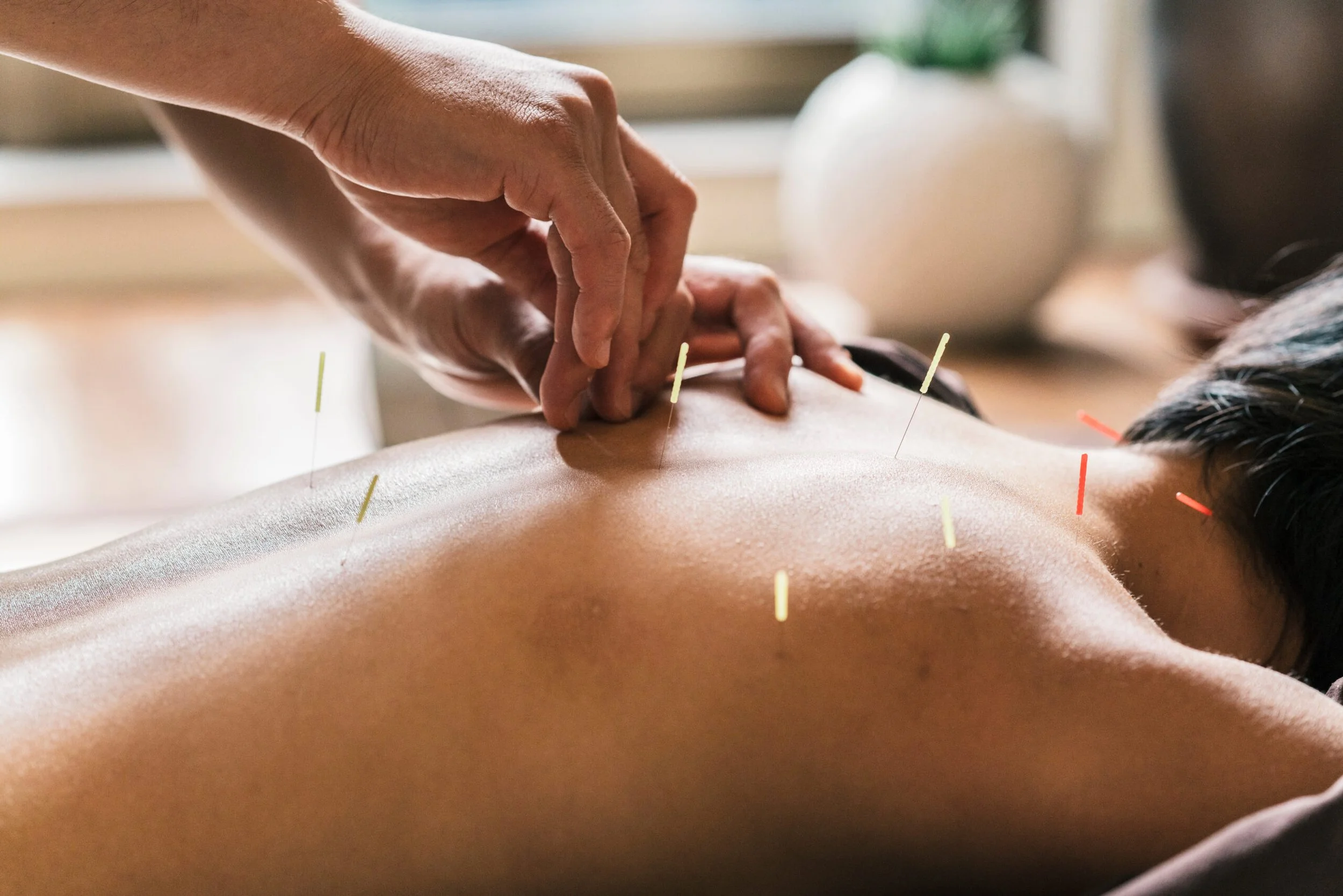 A person receiving acupuncture treatment with multiple thin needles inserted into their back, while a practitioner gently adjusts one of the needles.