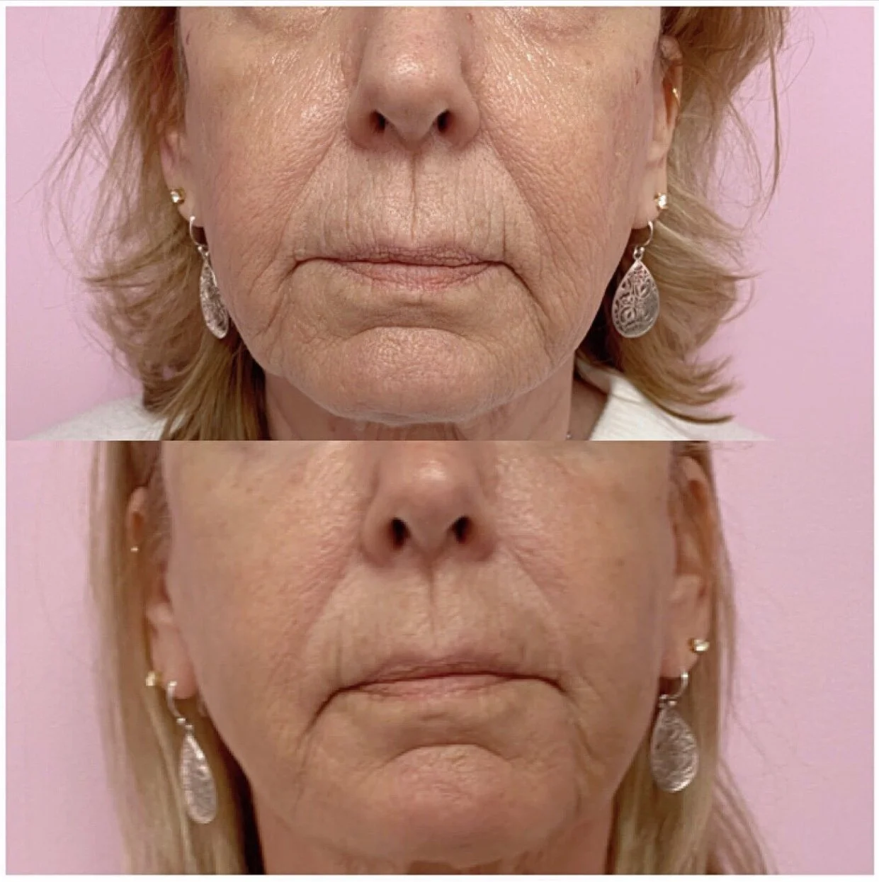Threading Skin PDO Thread Lifting and Facial Contouring — SanaVitta Wellness Center ...