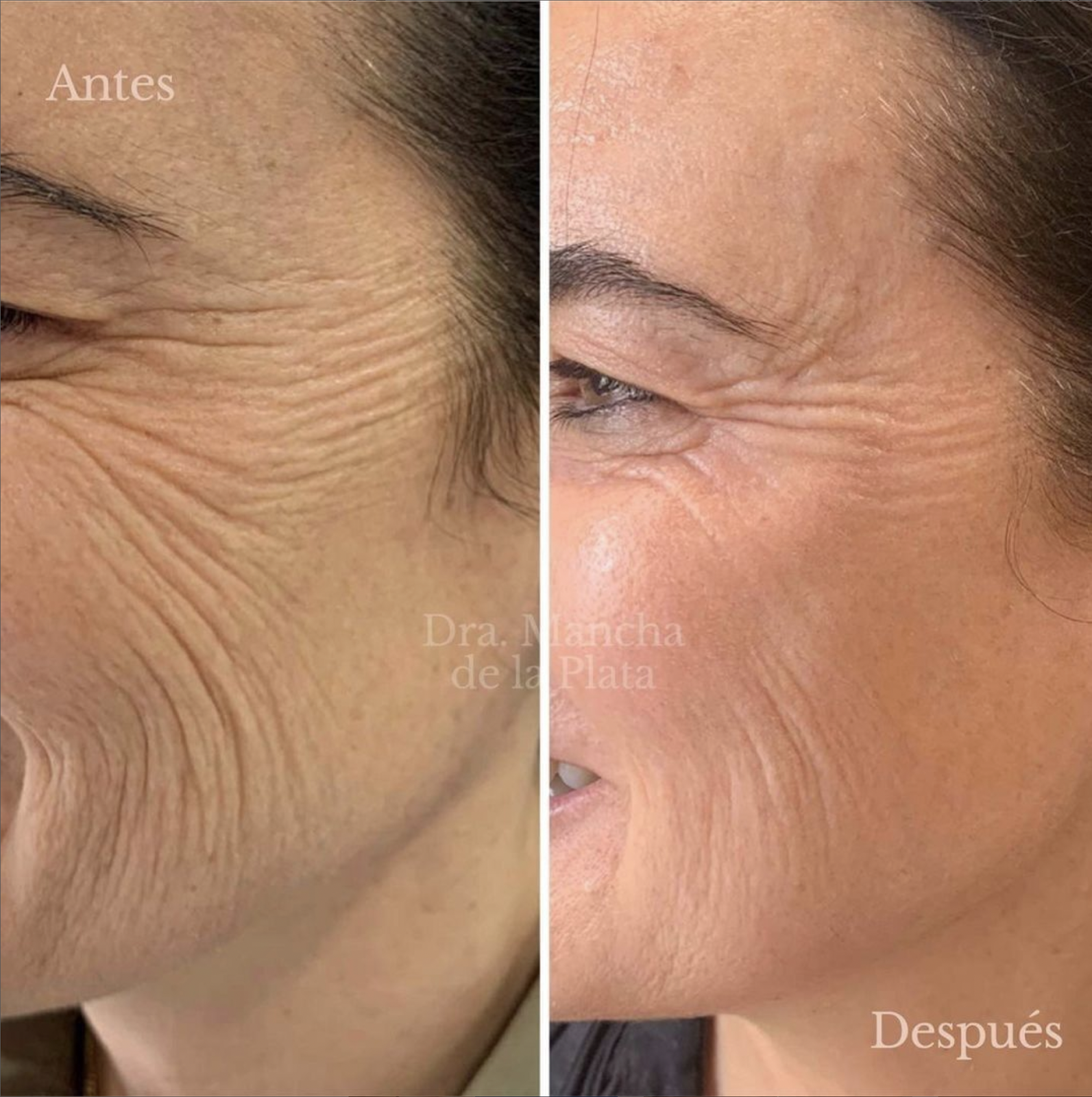 Neo Elite┬« - NeoSkin┬« - Skin Rejuvenation (5).png