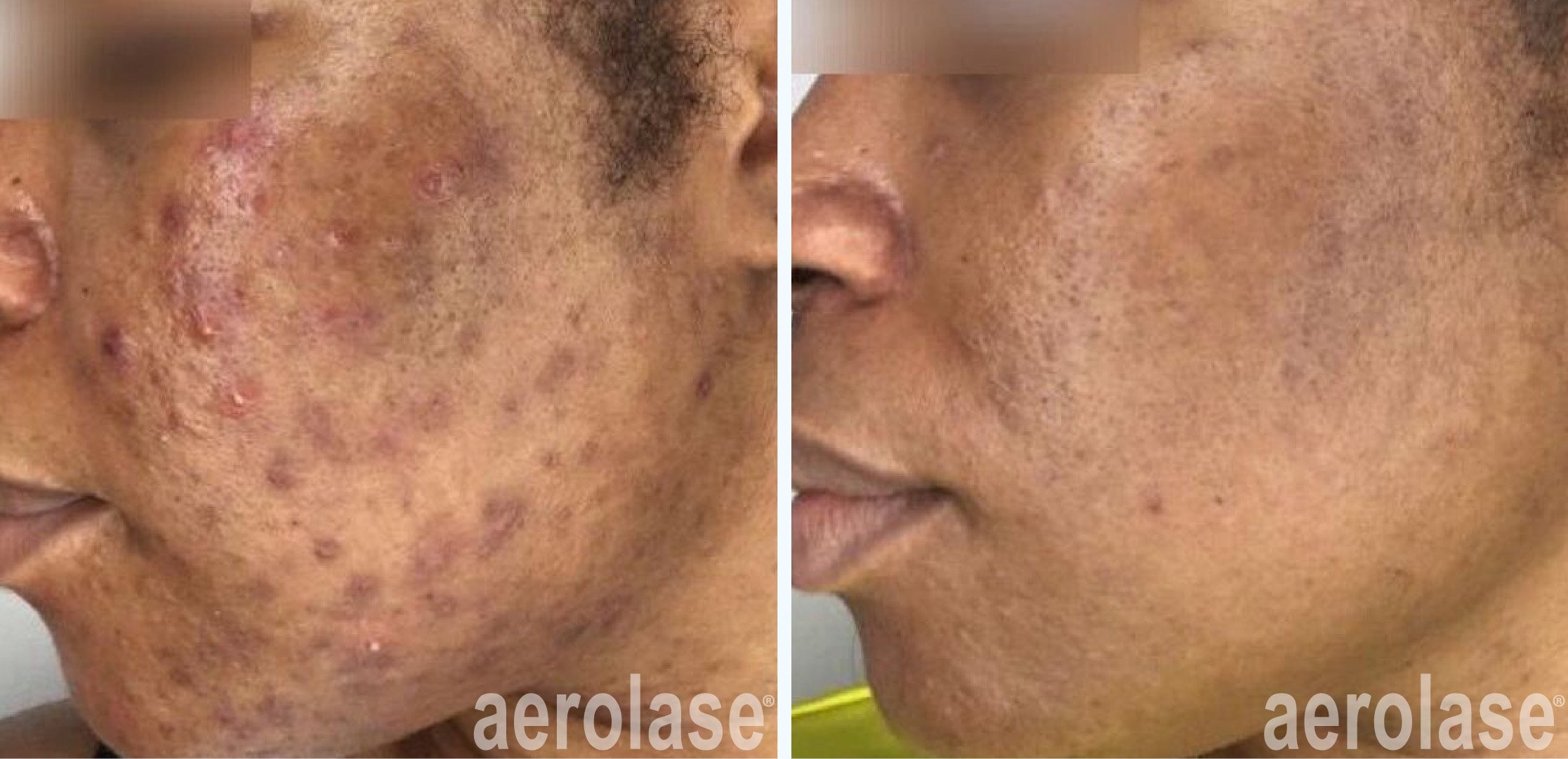 111acne-cheeks-sholema-skinofcolor-before-and-after-1.jpg