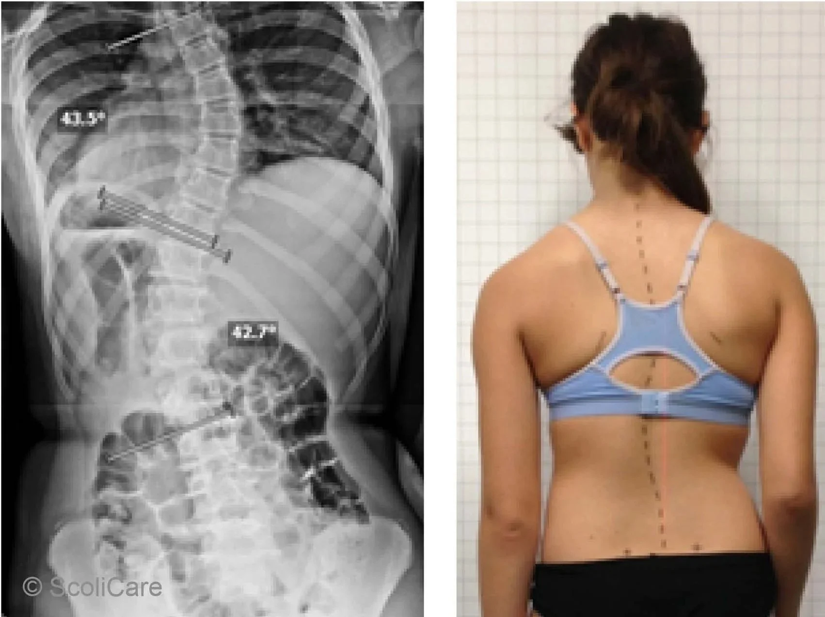 Scoliosis Awareness 