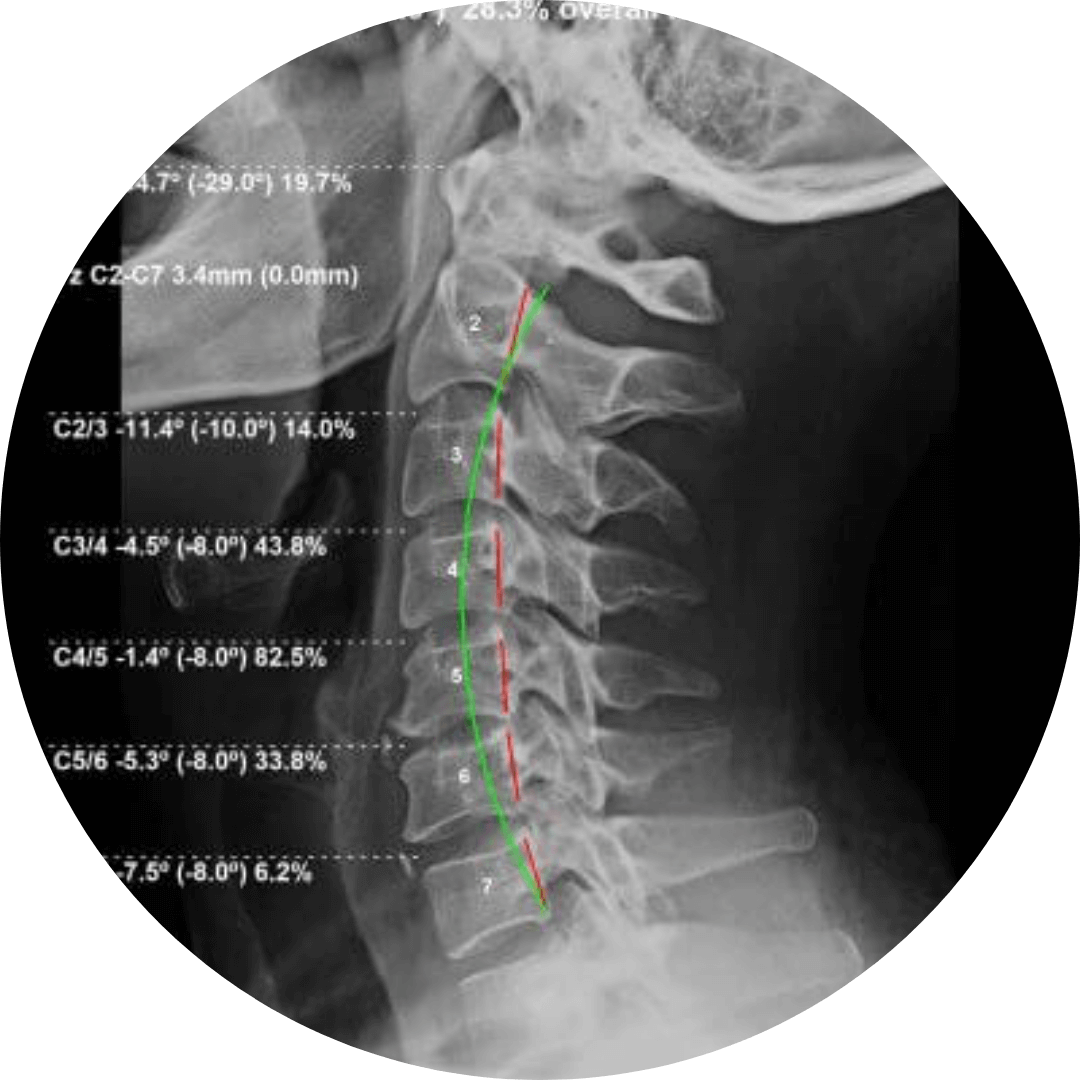 chiropractic biophysics xray after treatment