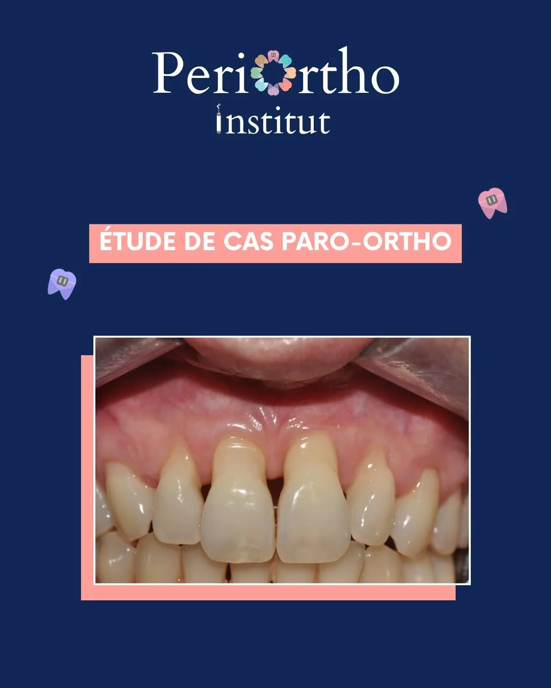 Patiente tr&egrave;s complex&eacute;e par son sourire.
Le but : Essayer de recr&eacute;er une papille inter-dentaire, le recouvrement total &eacute;tant impossible au vu de l&rsquo;alv&eacute;olyse.

Swipez pour d&eacute;couvrir le r&eacute;sultat &a