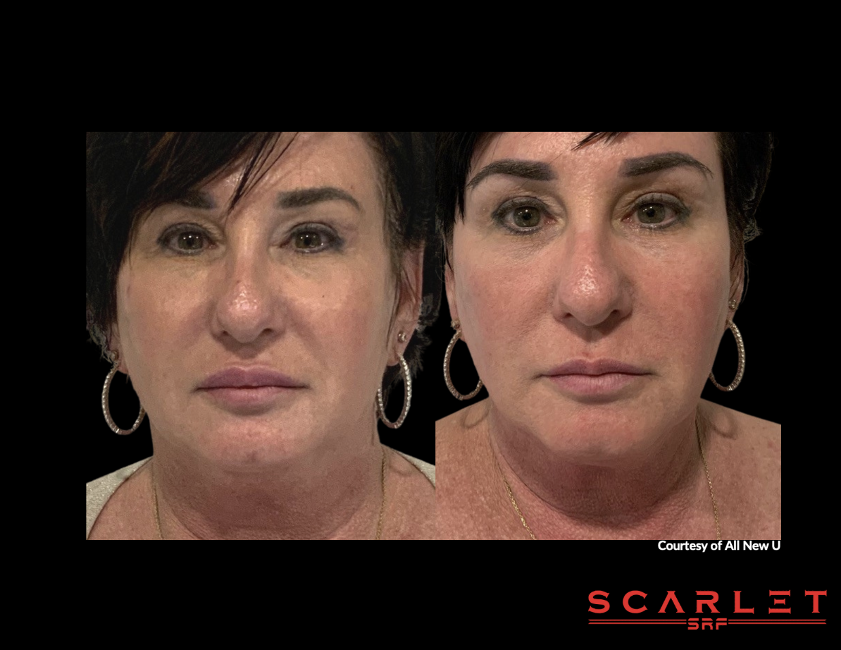 Comparison photo showing before and after images of a woman with short dark hair, wearing hoop earrings, with visible facial improvements.