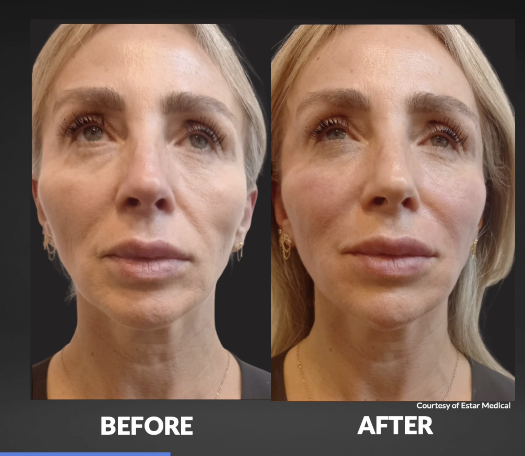 Comparison of a woman's face before and after a cosmetic procedure, showing smoother skin and reduced wrinkles in the after image.