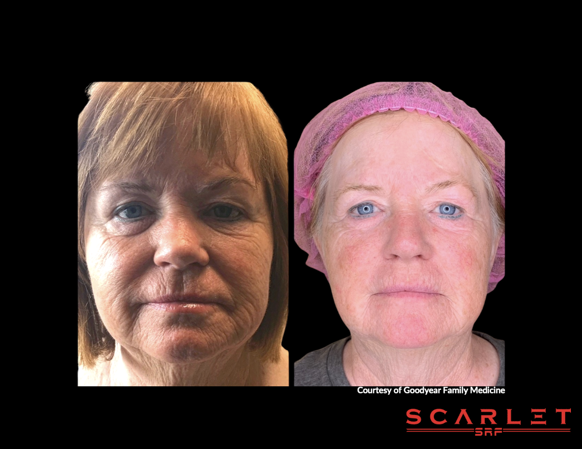 Side-by-side comparison of a woman's face before and after a cosmetic procedure, showing improvement in skin texture and appearance.