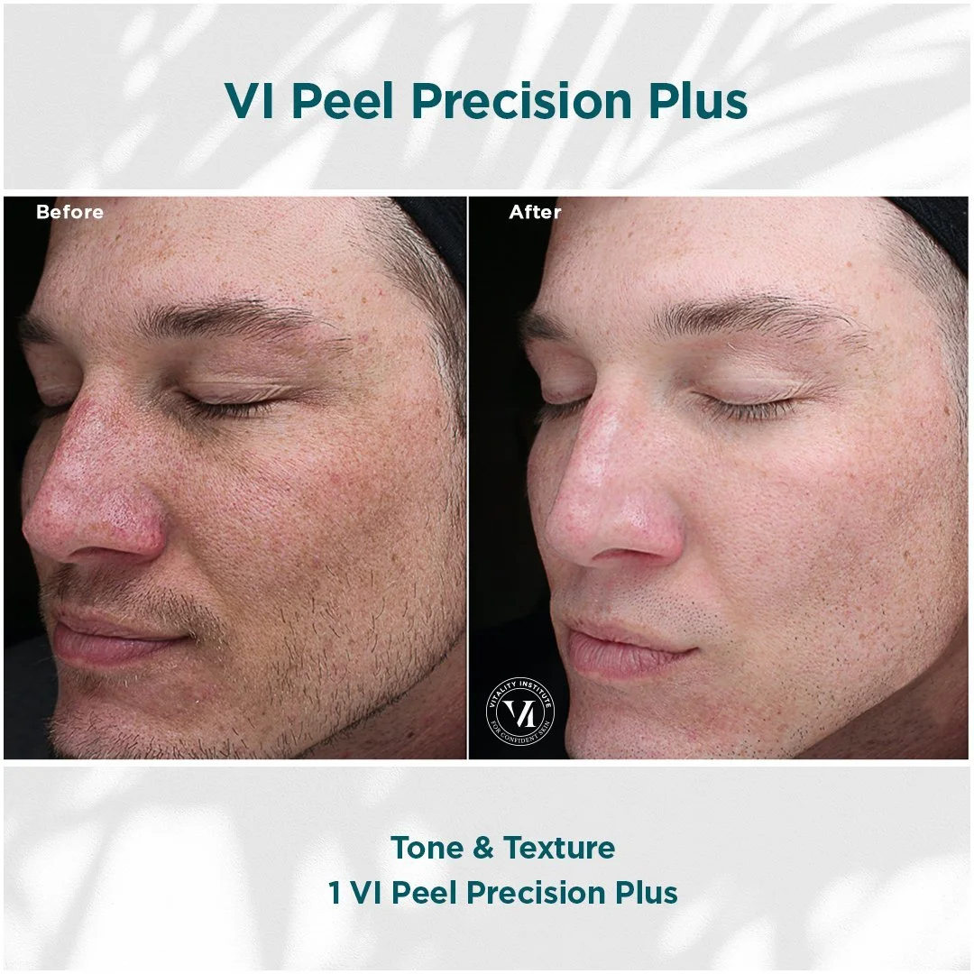 Before and after close-up images of a man's face showing skin improvement after using VI Peel Precision Plus, with smoother, clearer skin in the after photo.