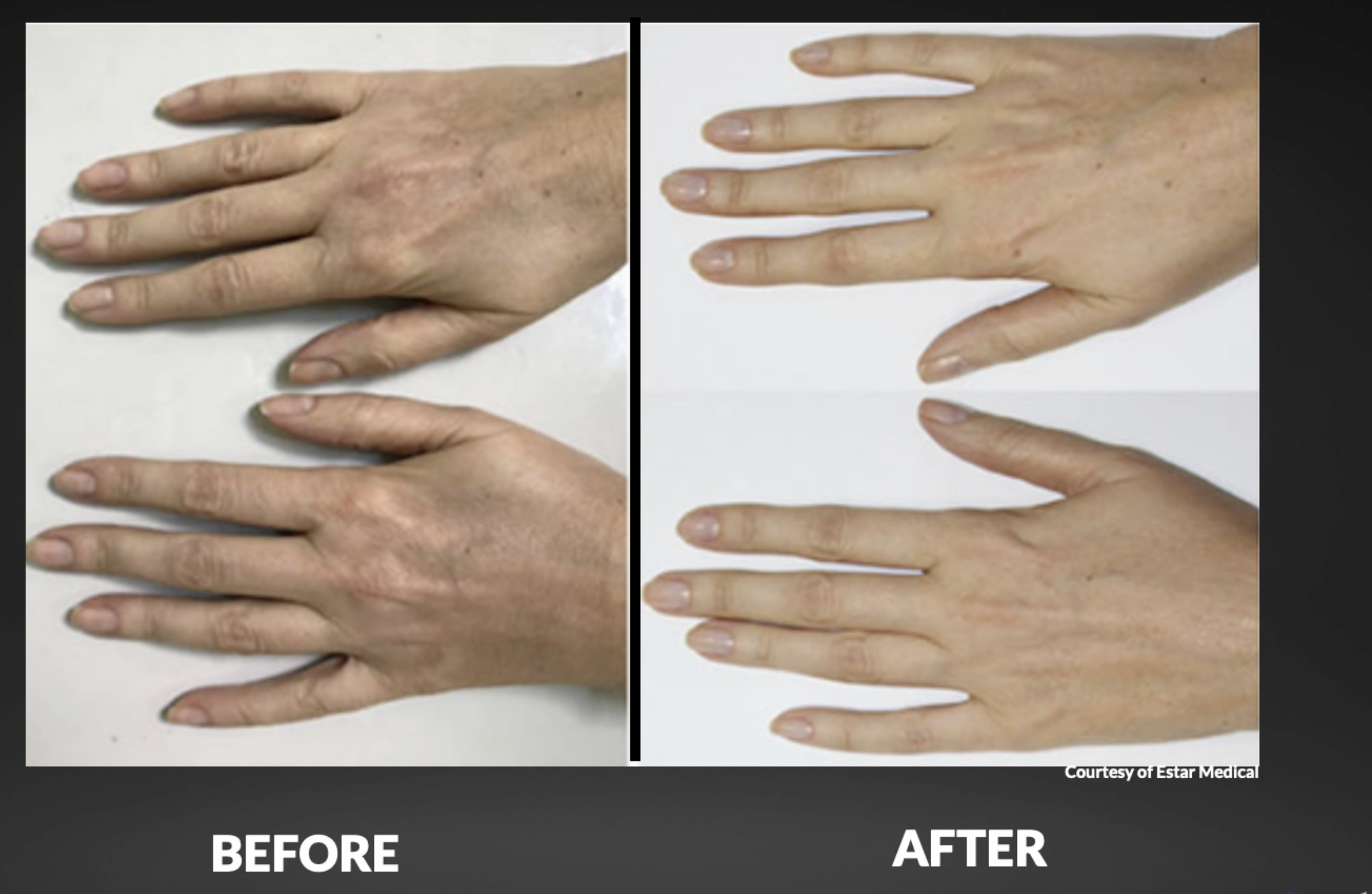 Comparison of hands before and after treatment, showing improved skin appearance and texture in the after image.