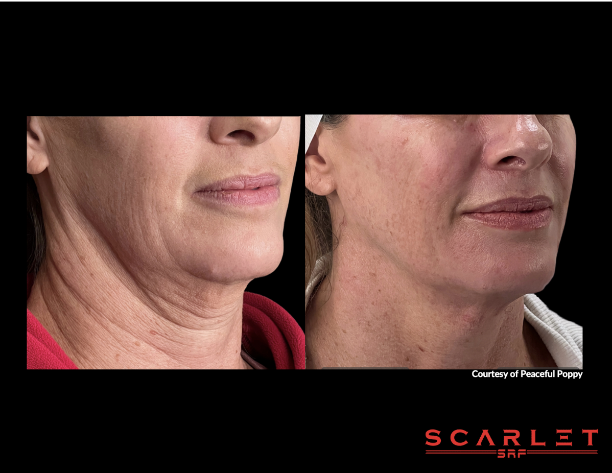 Side-by-side comparison of a woman's face before and after skincare treatment, highlighting reduced wrinkles and improved skin texture on the left and more evident skin blemishes and redness on the right.